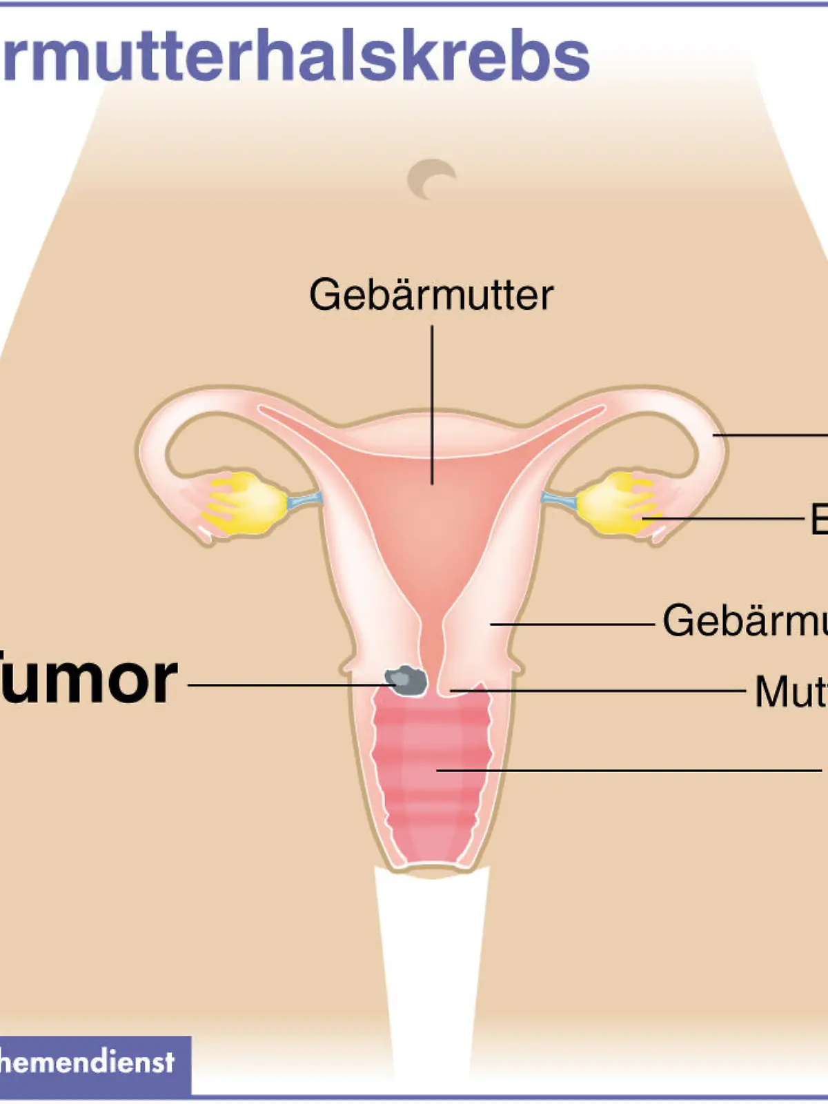 Zum Themendienst-Bericht "Früherkennung von Gebärmutterhalskrebs: Wann lohnt ein HPV-Test?" von Arnd Petry vom 26. März 2014: Humane Papillomviren können die Zellen in der Gebärmutterschleimhaut so verändern, dass im Gebärmutterhals ein Tumor entsteht. (Die Veröffentlichung ist für dpa-Themendienst-Bezieher honorarfrei.)