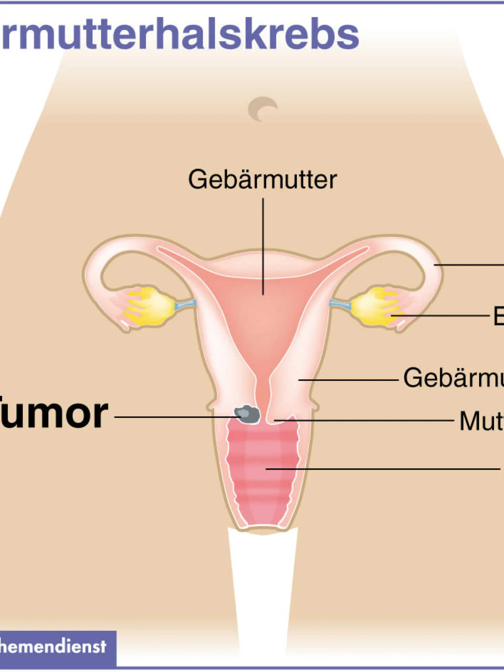 Zum Themendienst-Bericht "Früherkennung von Gebärmutterhalskrebs: Wann lohnt ein HPV-Test?" von Arnd Petry vom 26. März 2014: Humane Papillomviren können die Zellen in der Gebärmutterschleimhaut so verändern, dass im Gebärmutterhals ein Tumor entsteht. (Die Veröffentlichung ist für dpa-Themendienst-Bezieher honorarfrei.)