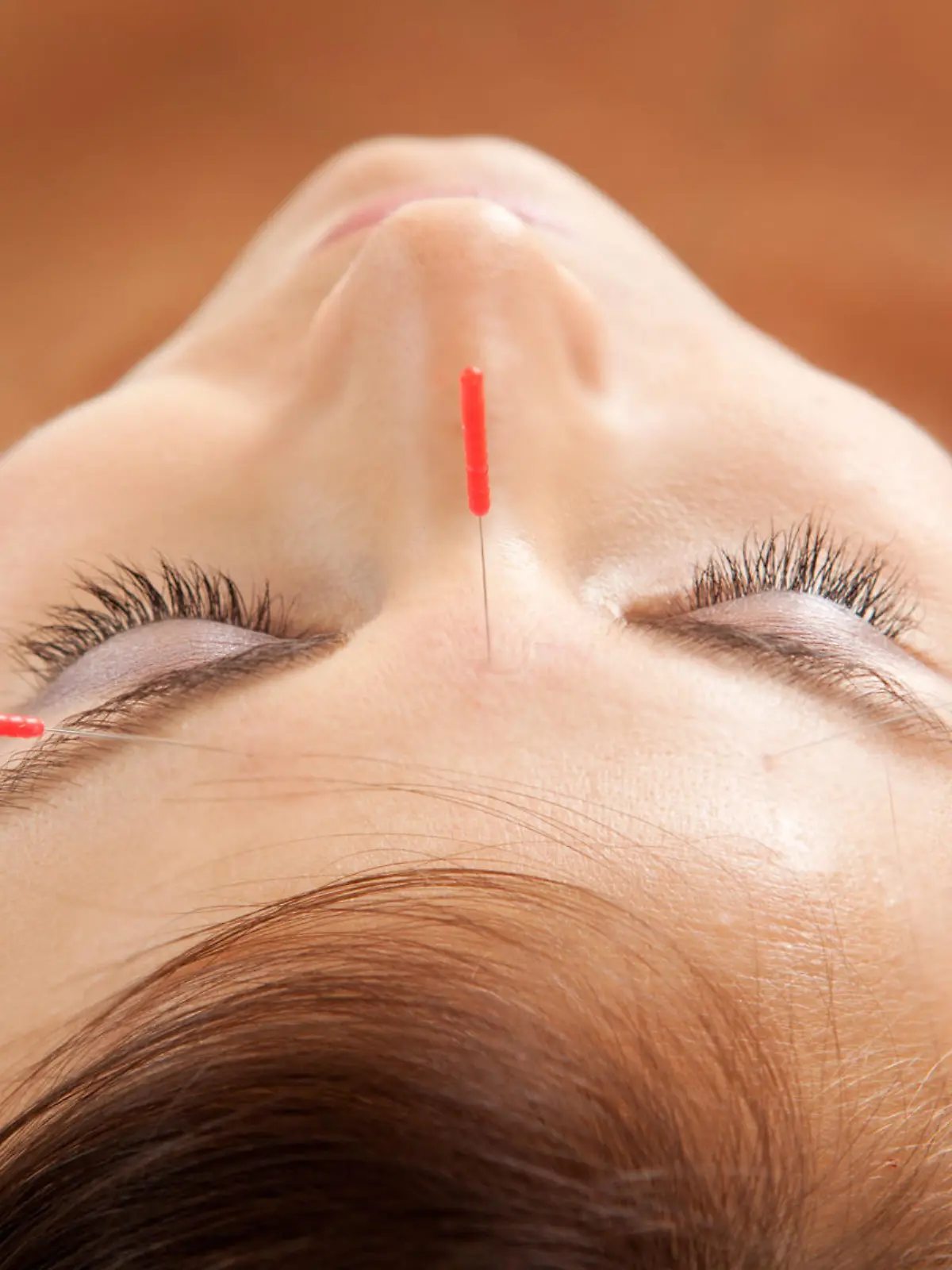 Anti-aging acupuncture treatment on young attractive female patient
