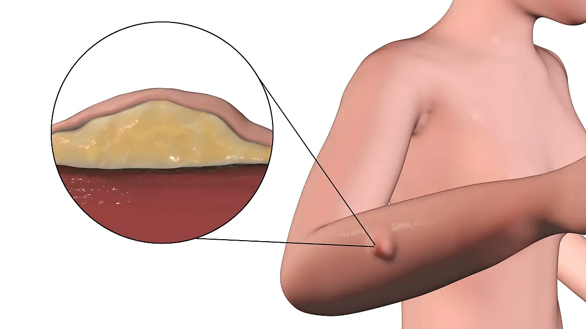 Lipoma, a growth of fat tissue under human skin, 3D illustration showing lipoma on the female arm and its cross-section