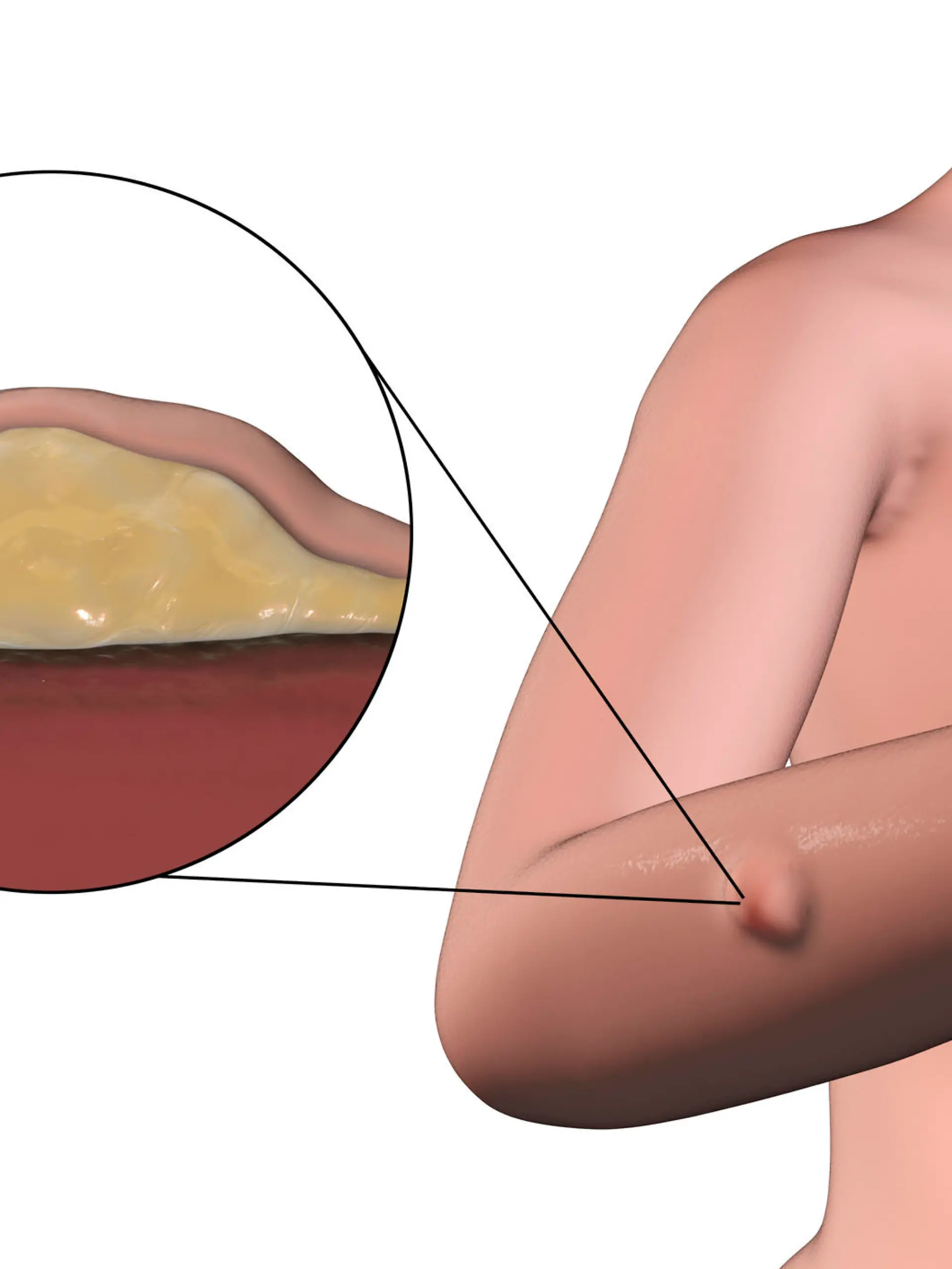 Lipoma, a growth of fat tissue under human skin, 3D illustration showing lipoma on the female arm and its cross-section