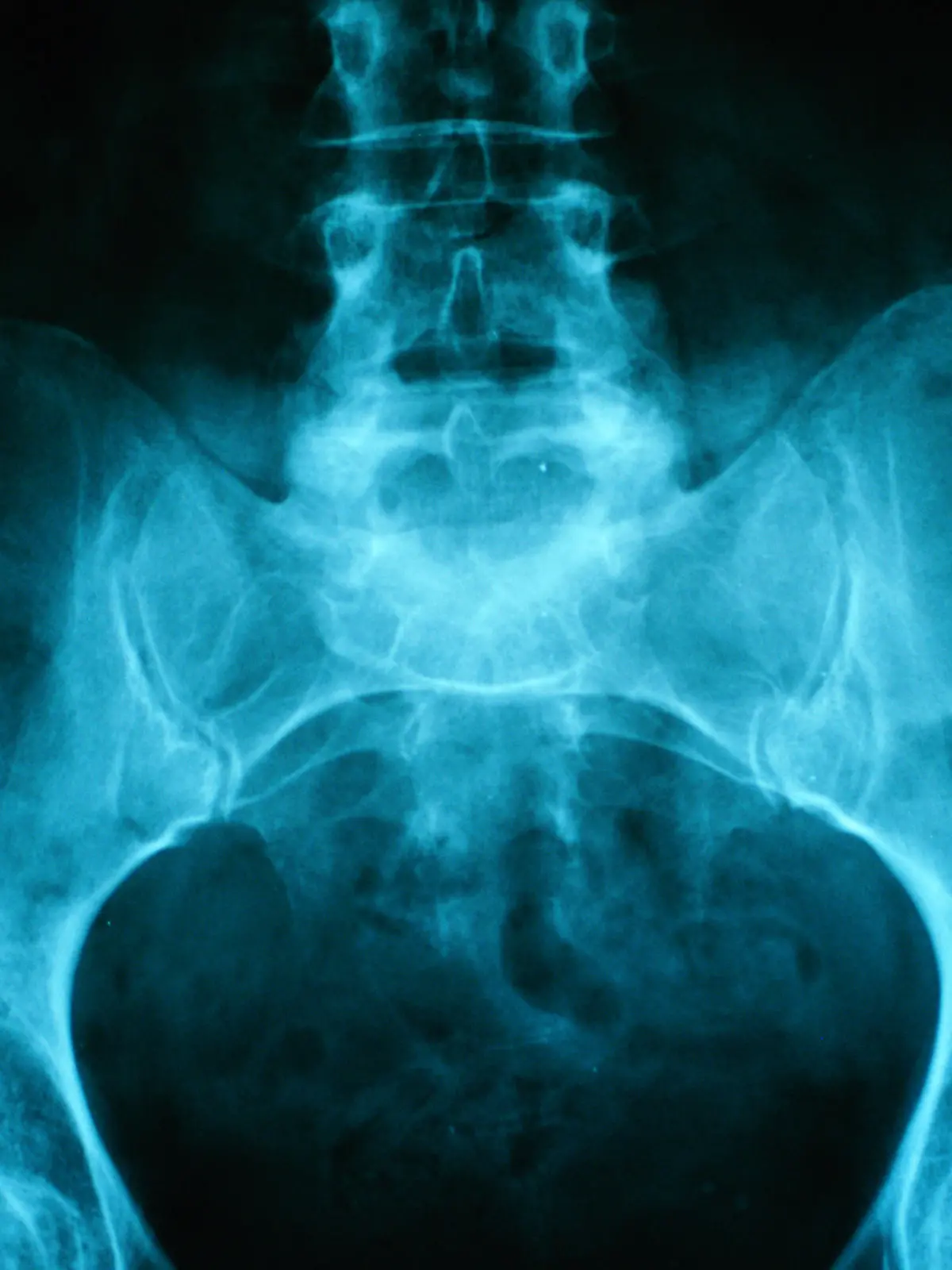 Medizin Radiologie

Röntgenaufnahme Becken mit Hüftgelenk und Lendenwirbelsäule von Frau medicine radiology x-ray of pelvis