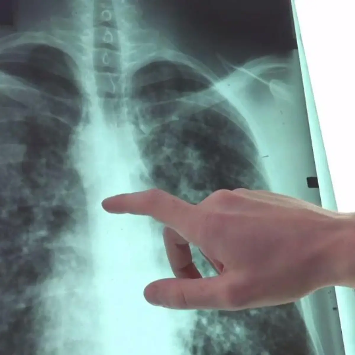 Lungenemphysem Logo von Lungenemphysem