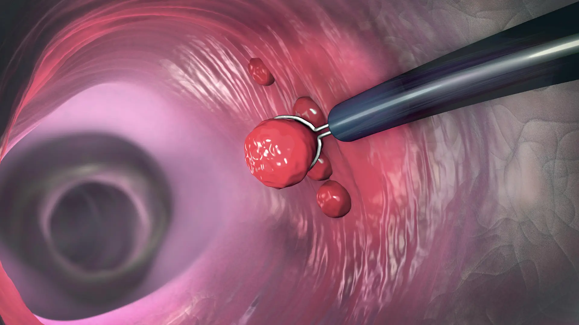 Removal of a colonic polyp with a electrical wire loop during a colonoscopy - 3d illustration