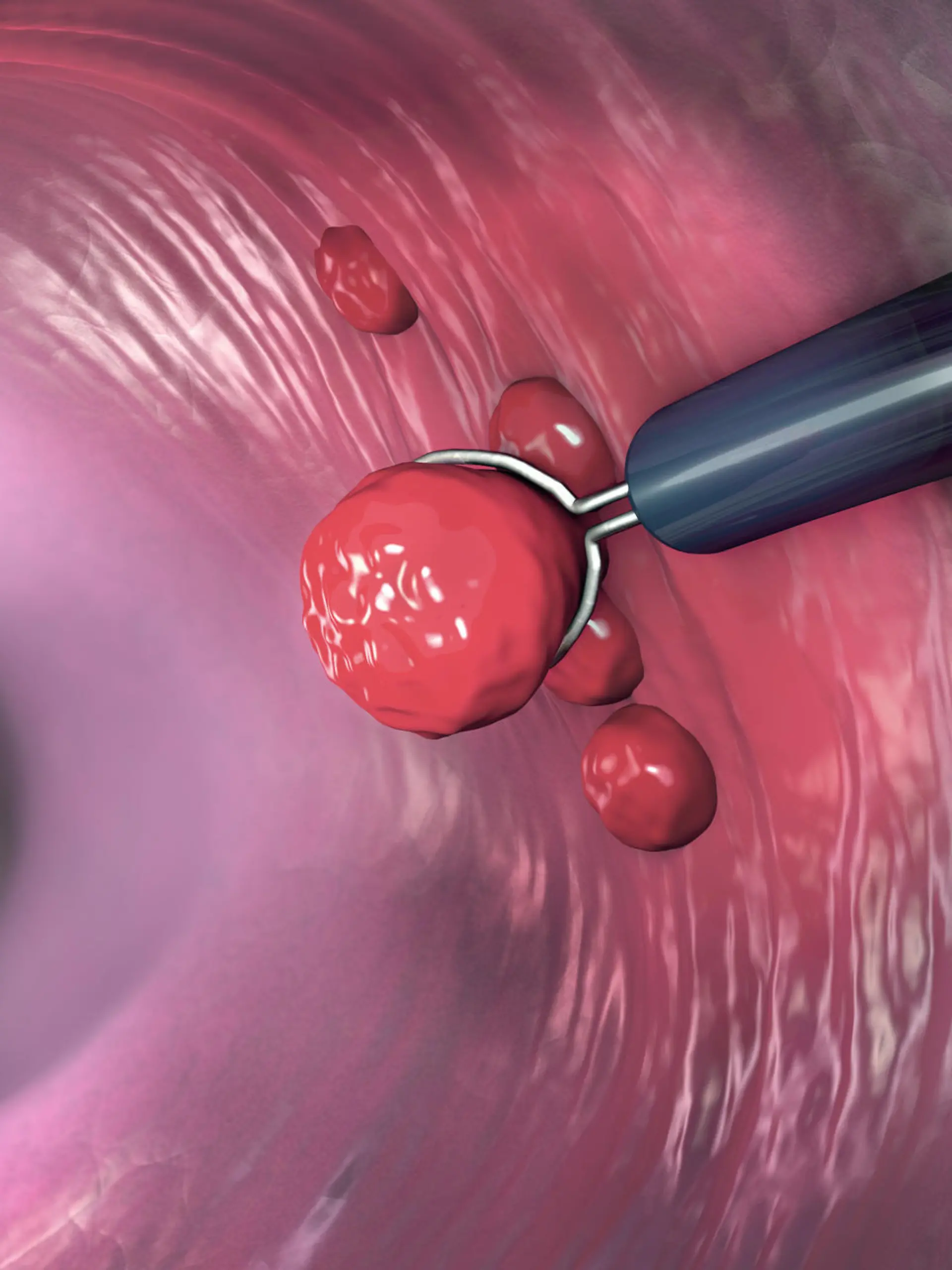 Removal of a colonic polyp with a electrical wire loop during a colonoscopy - 3d illustration