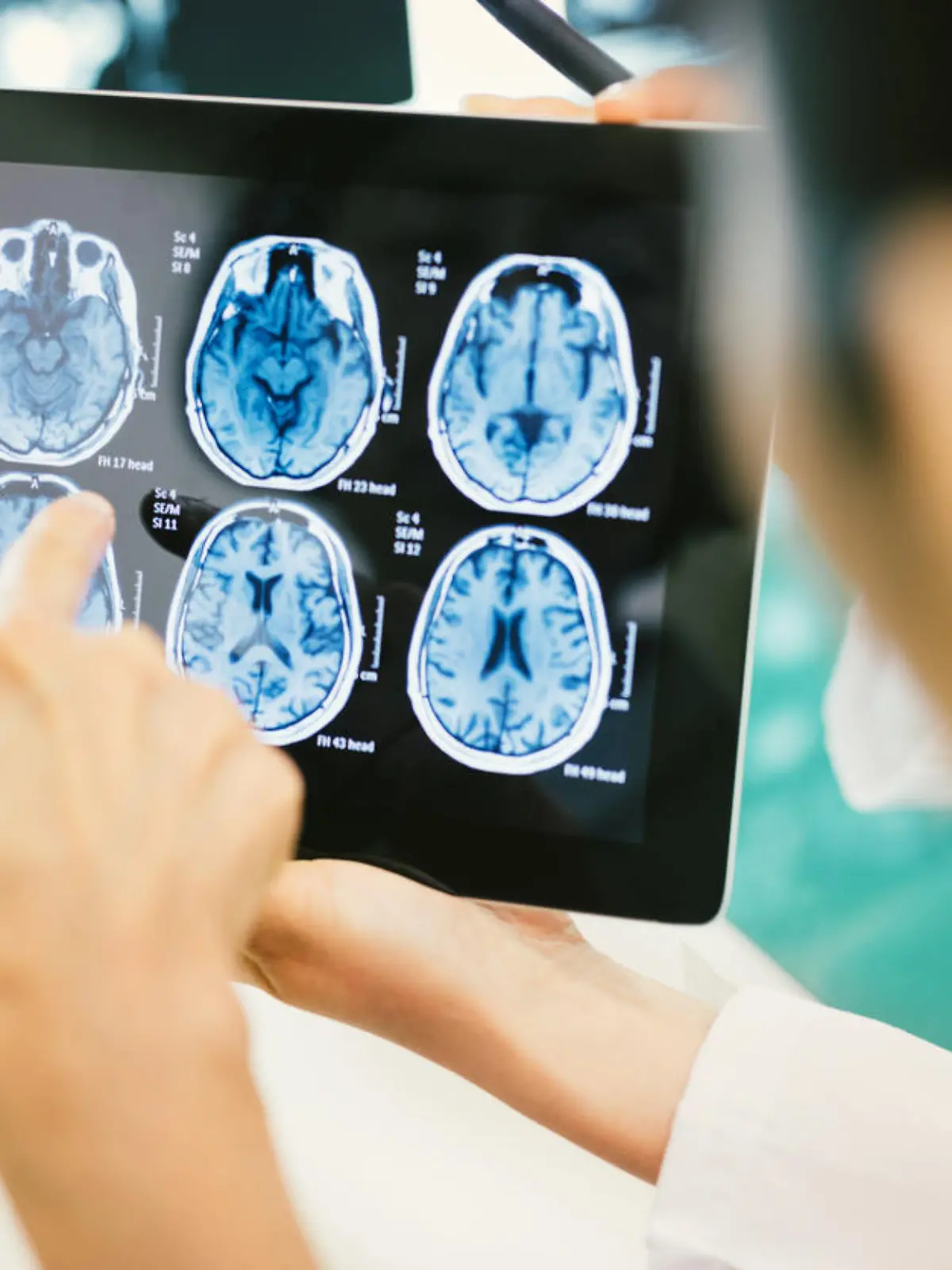 Ärzte schauen auf Hirn-Scans mit einem Hirntumor
