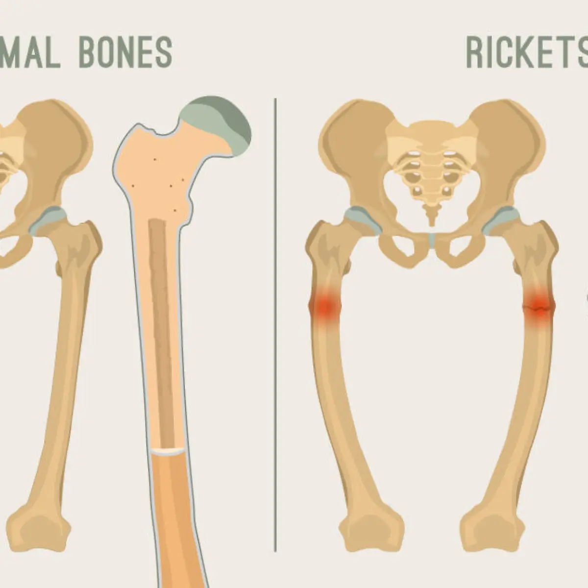 Rachitis (Knochenerweichung) Logo von Rachitis (Knochenerweichung)
