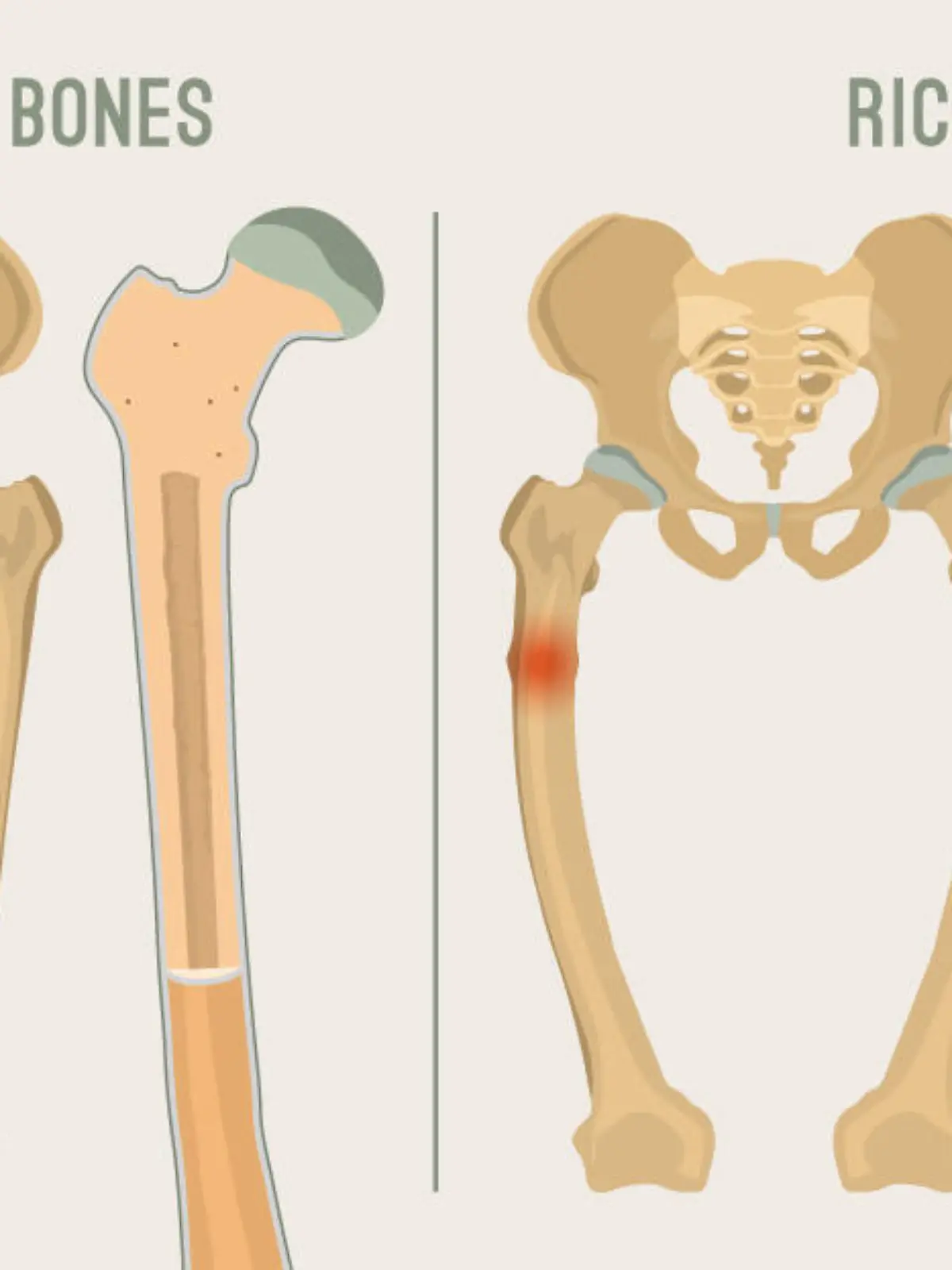 Normale Knochen im Vergleich zu Rachitis und Osteomalazie.