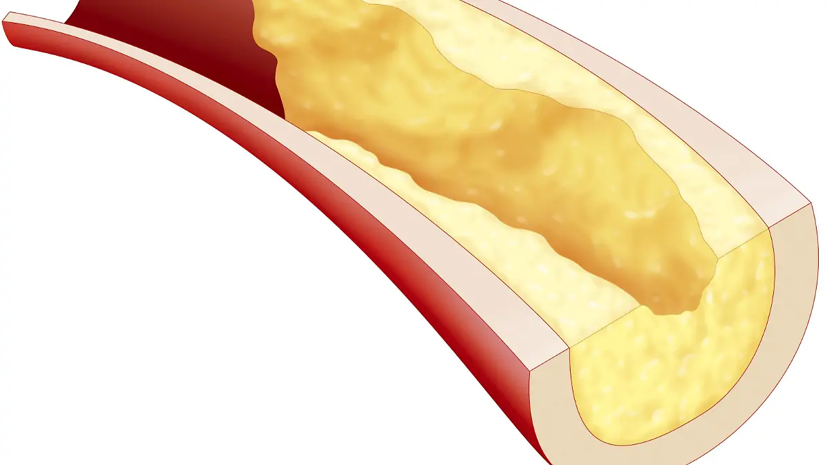 Illustration of an atheromatous plaque which obstructs the lumen of a large artery, such as coronary arteries, and reduces blood flow. | Verwendung weltweit, Keine Weitergabe an Wiederverkäufer.