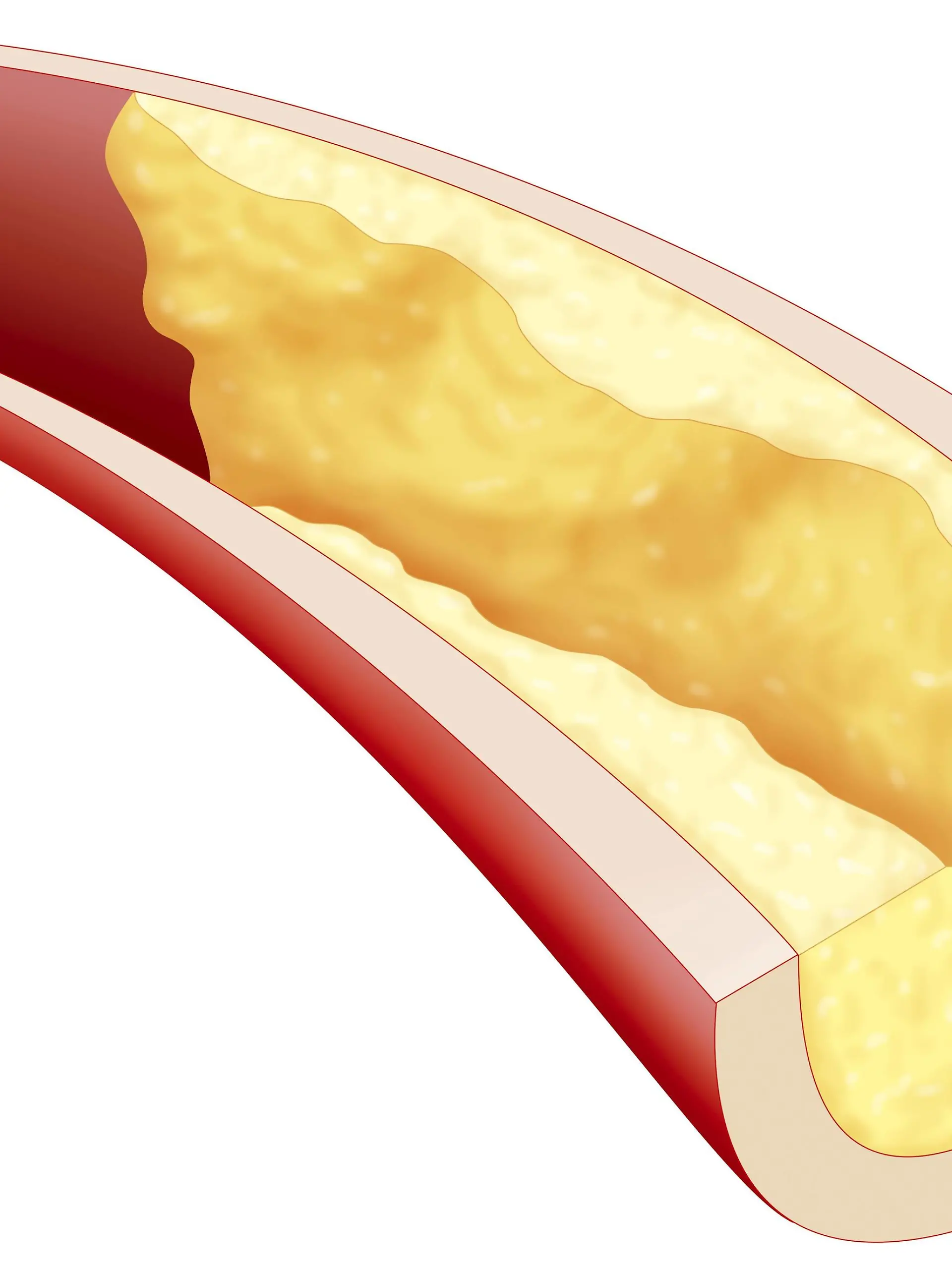 Illustration of an atheromatous plaque which obstructs the lumen of a large artery, such as coronary arteries, and reduces blood flow. | Verwendung weltweit, Keine Weitergabe an Wiederverkäufer.