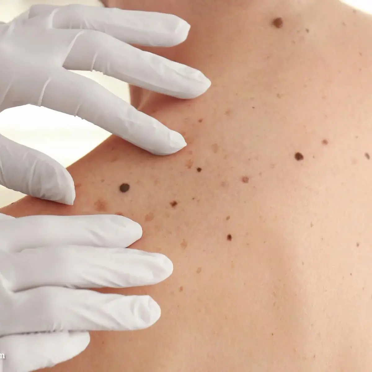 Schwarzer Hautkrebs (Malignes Melanom) Logo von Schwarzer Hautkrebs (Malignes Melanom)