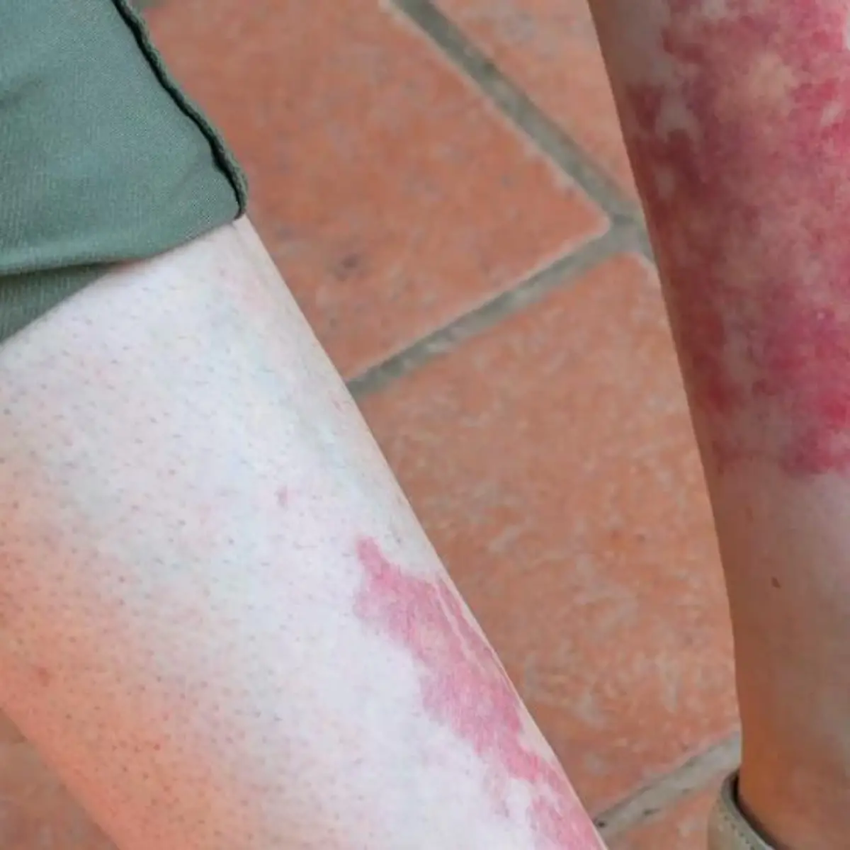 Vaskulitis Logo von Vaskulitis