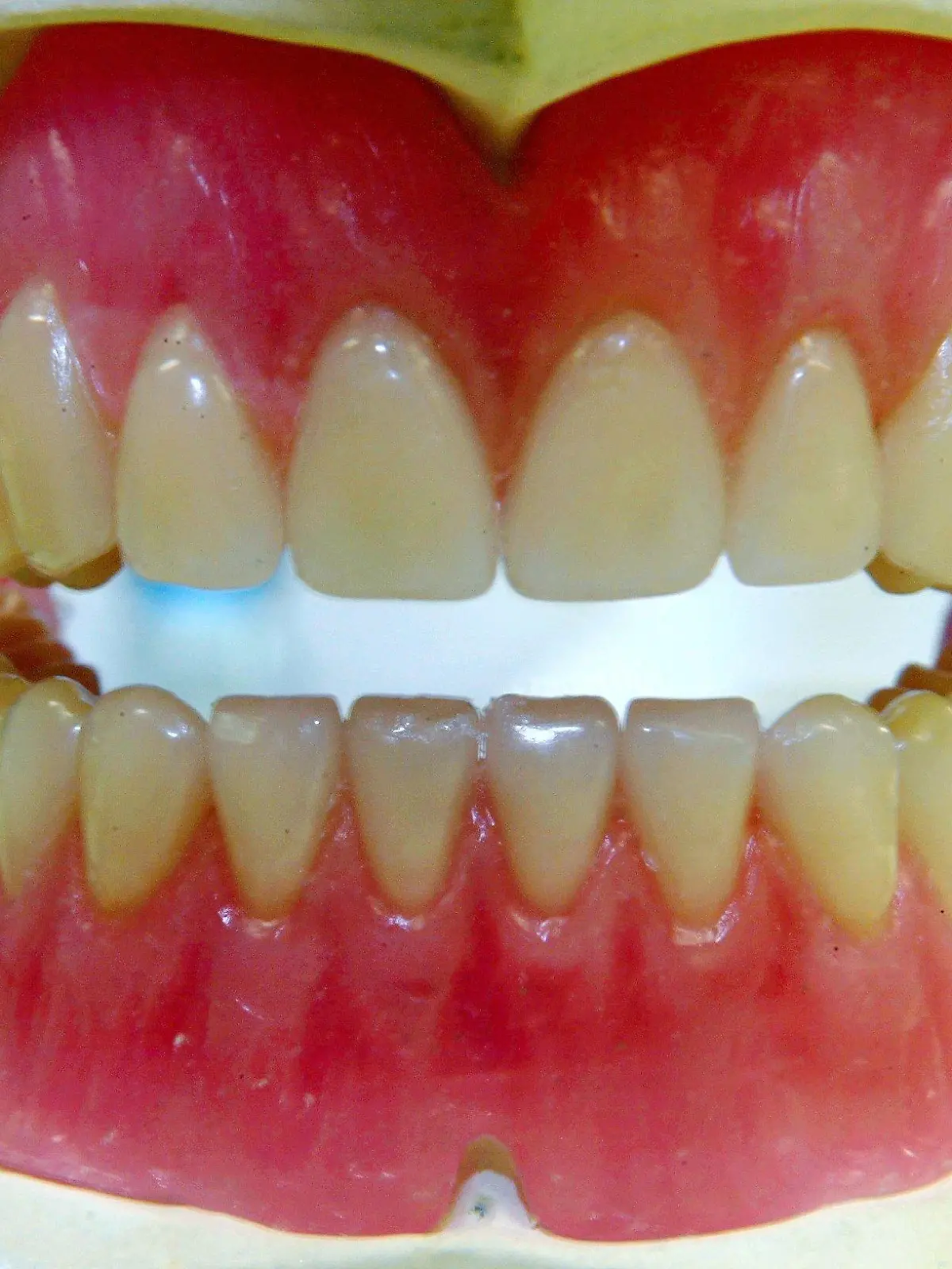 Ein Gebissmodell, aufgenommen am 21.11.2002 in einem Düsseldorfer Dentallabor. Die Staatsanwaltschaft Wuppertal hat einen der größten Betrugsskandale im deutschen Gesundheitswesen aufgedeckt. Die Mülheimer Dentalgesellschaft Globudent soll Ärzten jahrelang billigen Zahnersatz aus China verkauft haben. Kassen und Patienten seien aber teure deutsche Preise berechnet worden. In den Skandal könnten nach Angaben der AOK bundesweit 2000 Ärzte verstrickt sein. Die Staatsanwaltschaft Wuppertal ließ inzwischen vier Menschen festnehmen, darunter den Geschäftsführer von Globudent.