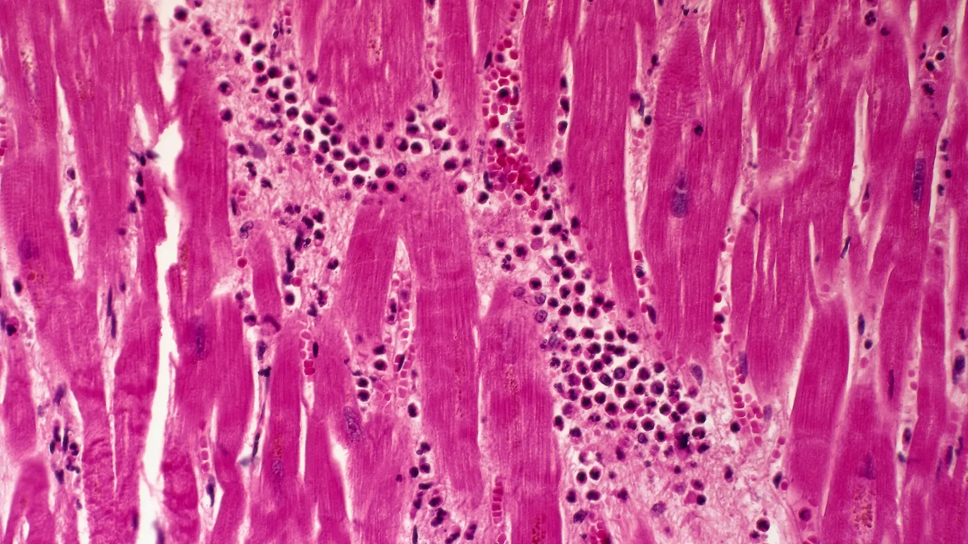 Medizin Pathologie
Kreislaufsystem Herzinfarkt Herzmuskulatur mit Nekrose und entzündlicher Infiltration Mikroaufnahme Vergrößerung 64:1 medicine pathology myocardial infarction