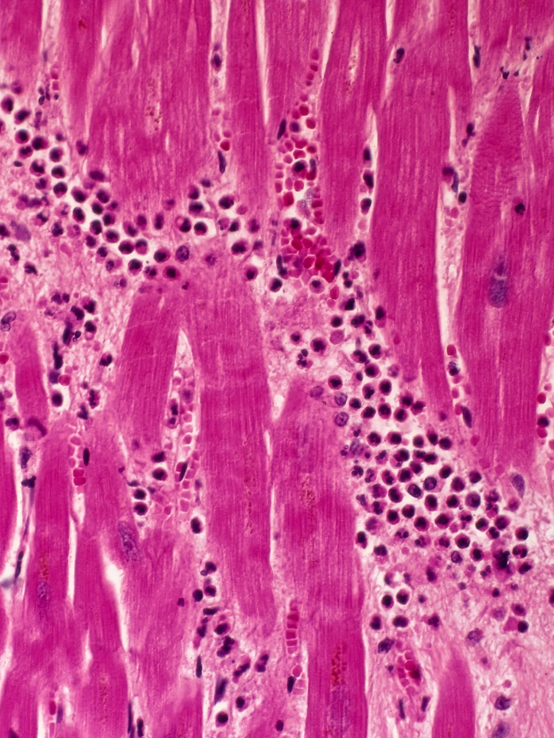 Medizin Pathologie

Kreislaufsystem Herzinfarkt Herzmuskulatur mit Nekrose und entzündlicher Infiltration Mikroaufnahme Vergrößerung 64:1 medicine pathology myocardial infarction