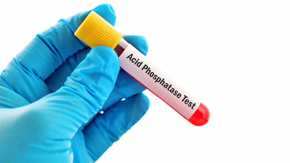 Saure Phosphatase Test