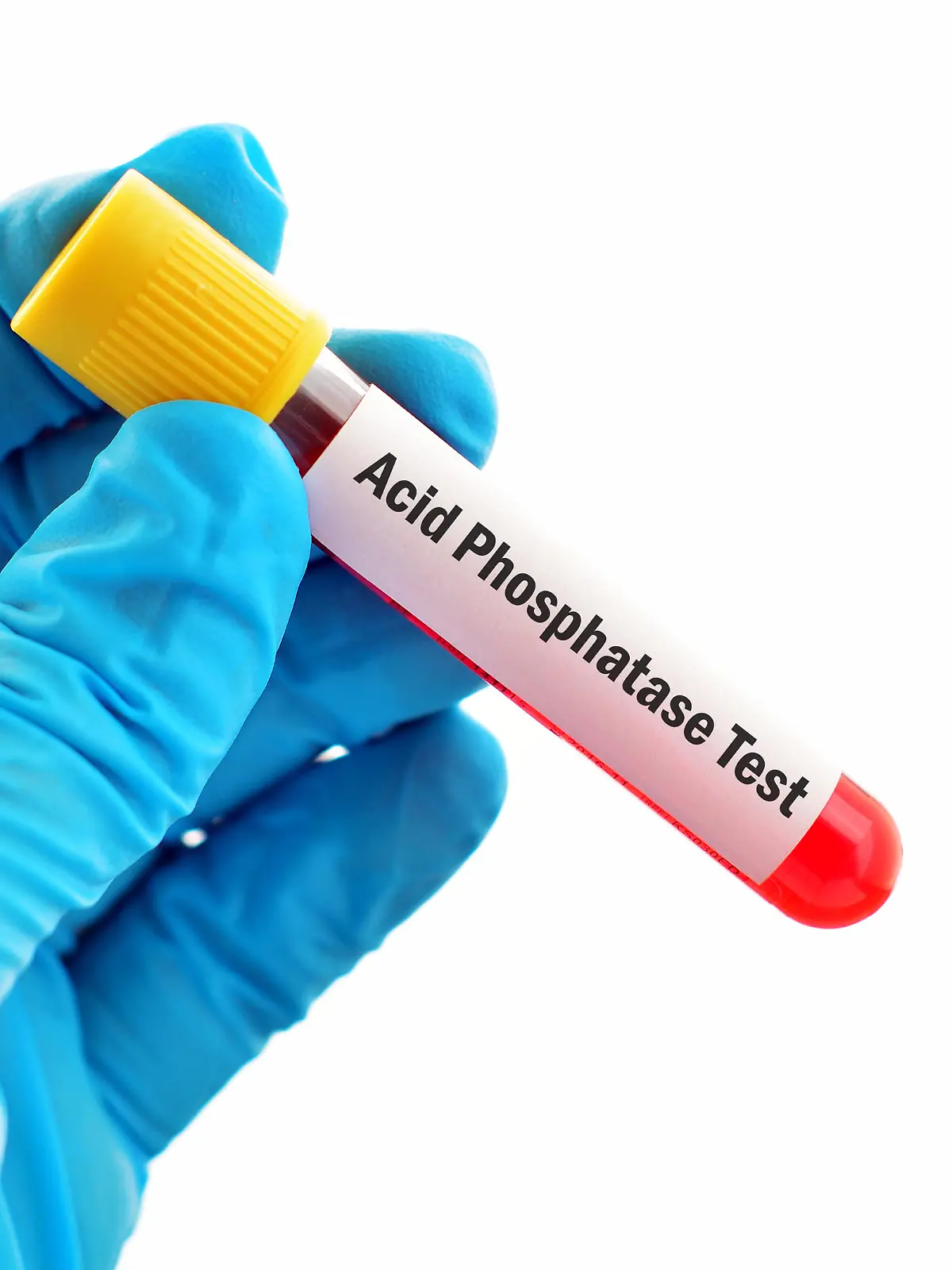 Saure Phosphatase Test