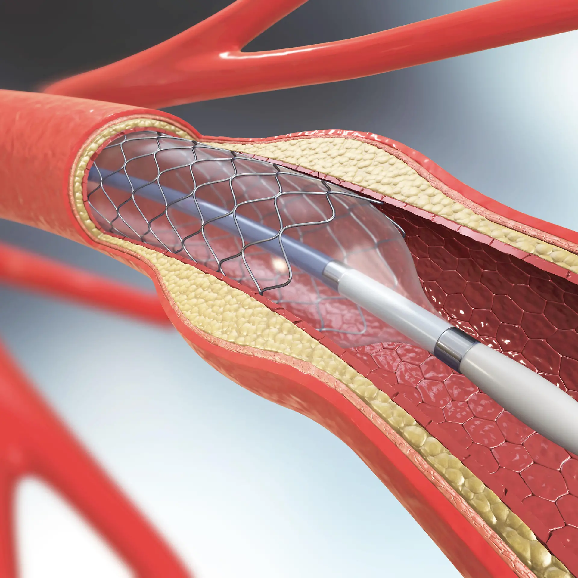 Stent (Stentimplantation) Logo von Stent (Stentimplantation)