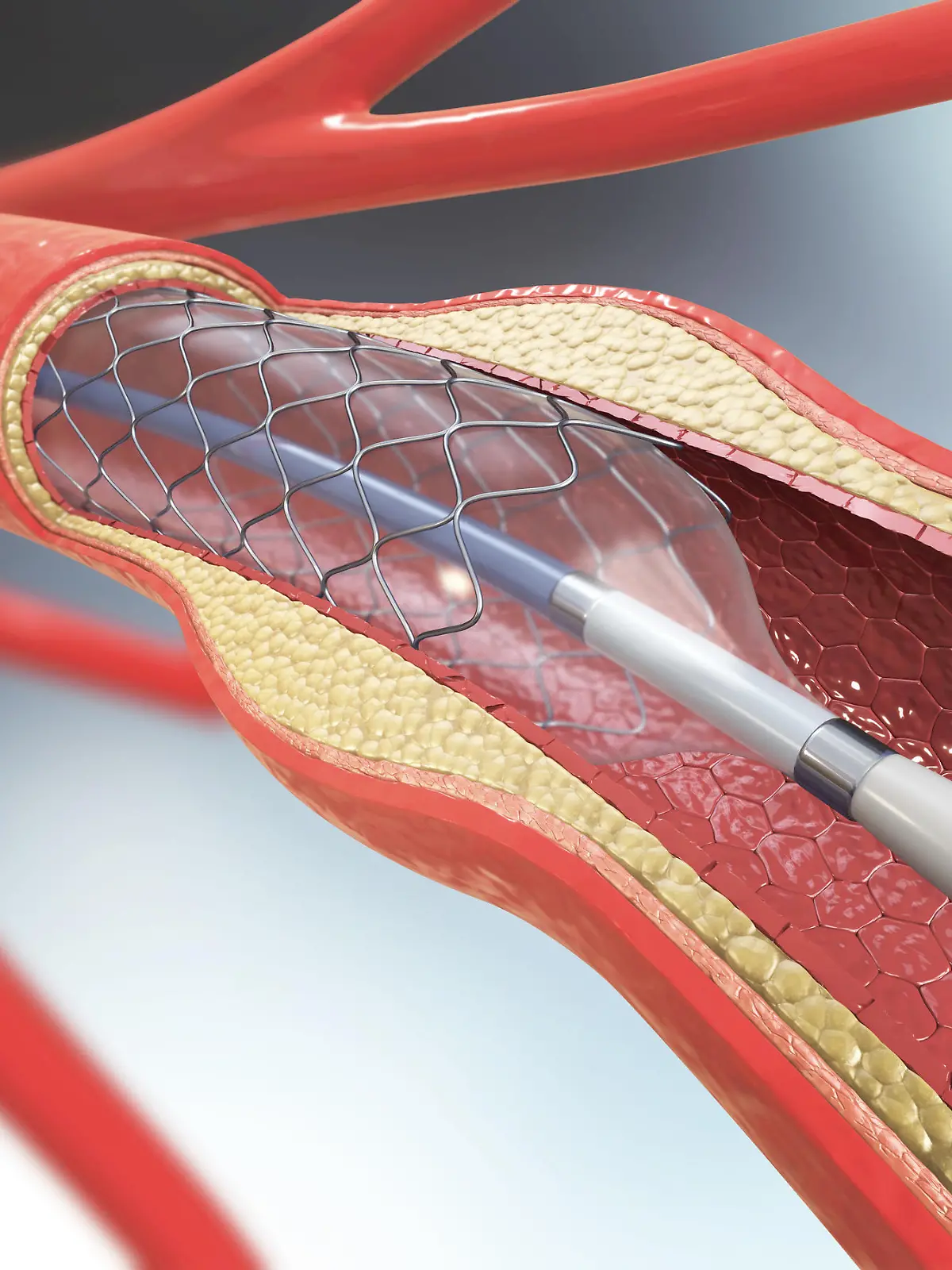 3D-Darstellung der Stent-Implantation zur Unterstützung der Durchblutung in den Gefäßen