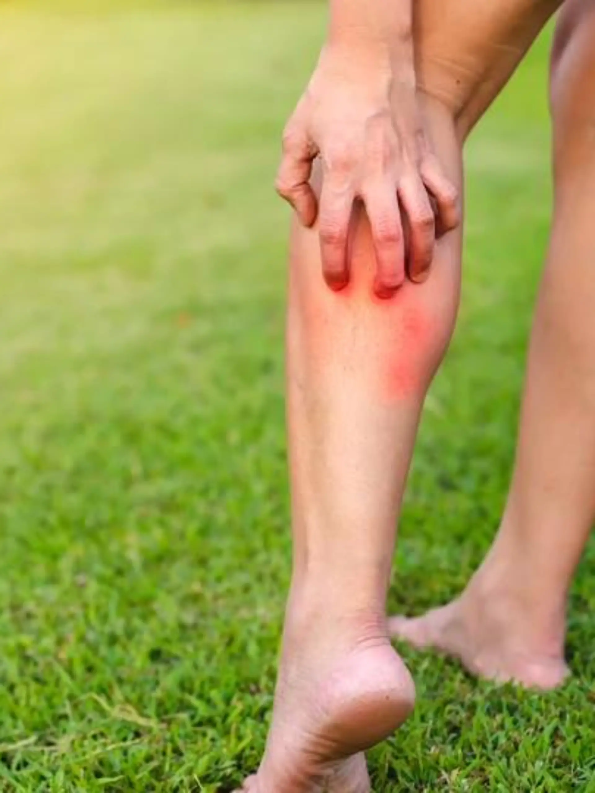Bild zu: "Erythema nodosum (Knotenrose)"
