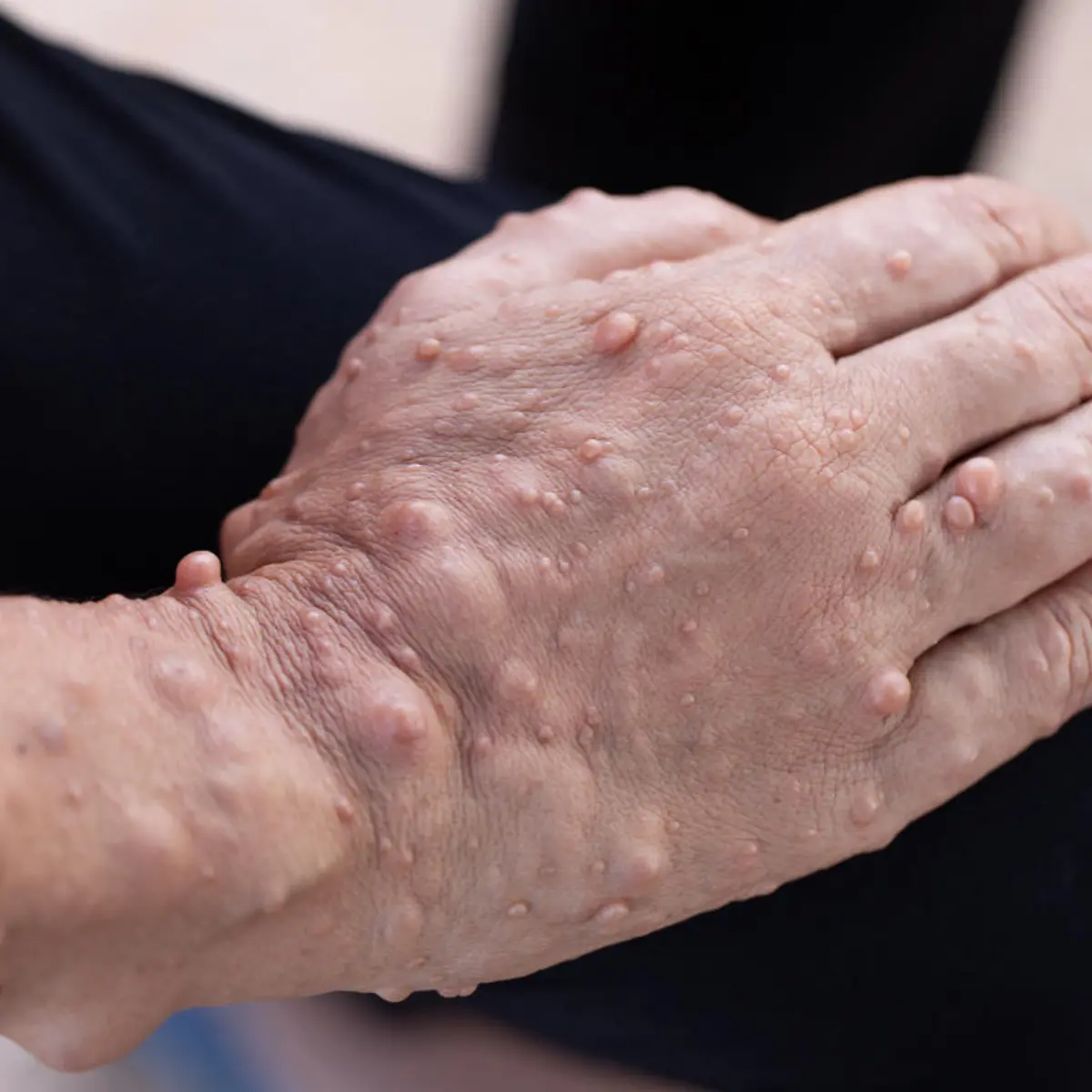 Neurofibromatose Logo von Neurofibromatose