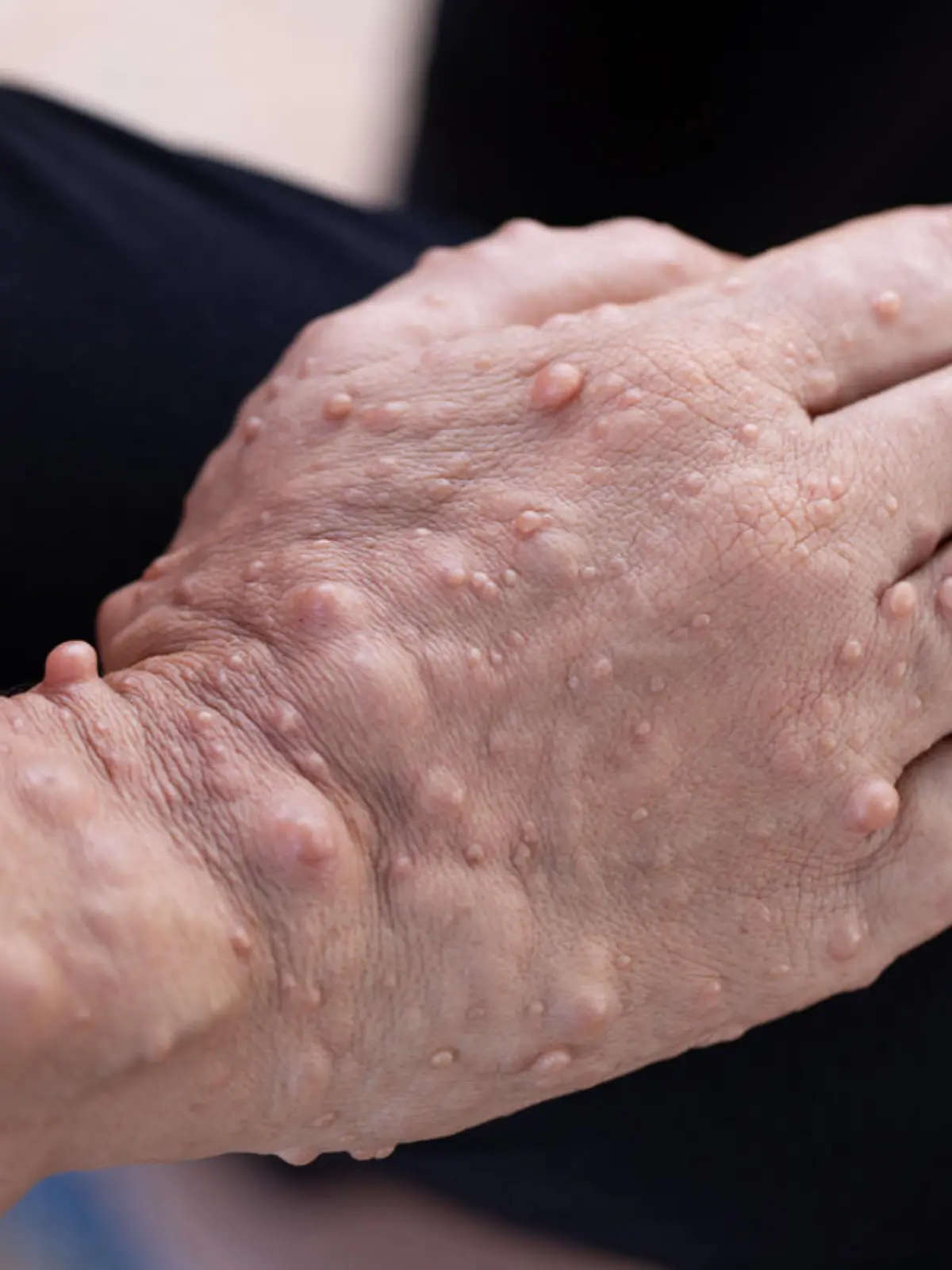 Symptom von Neurofibromatose: Eine Hand mit vielen kleinen Geschwülsten unter der Haut