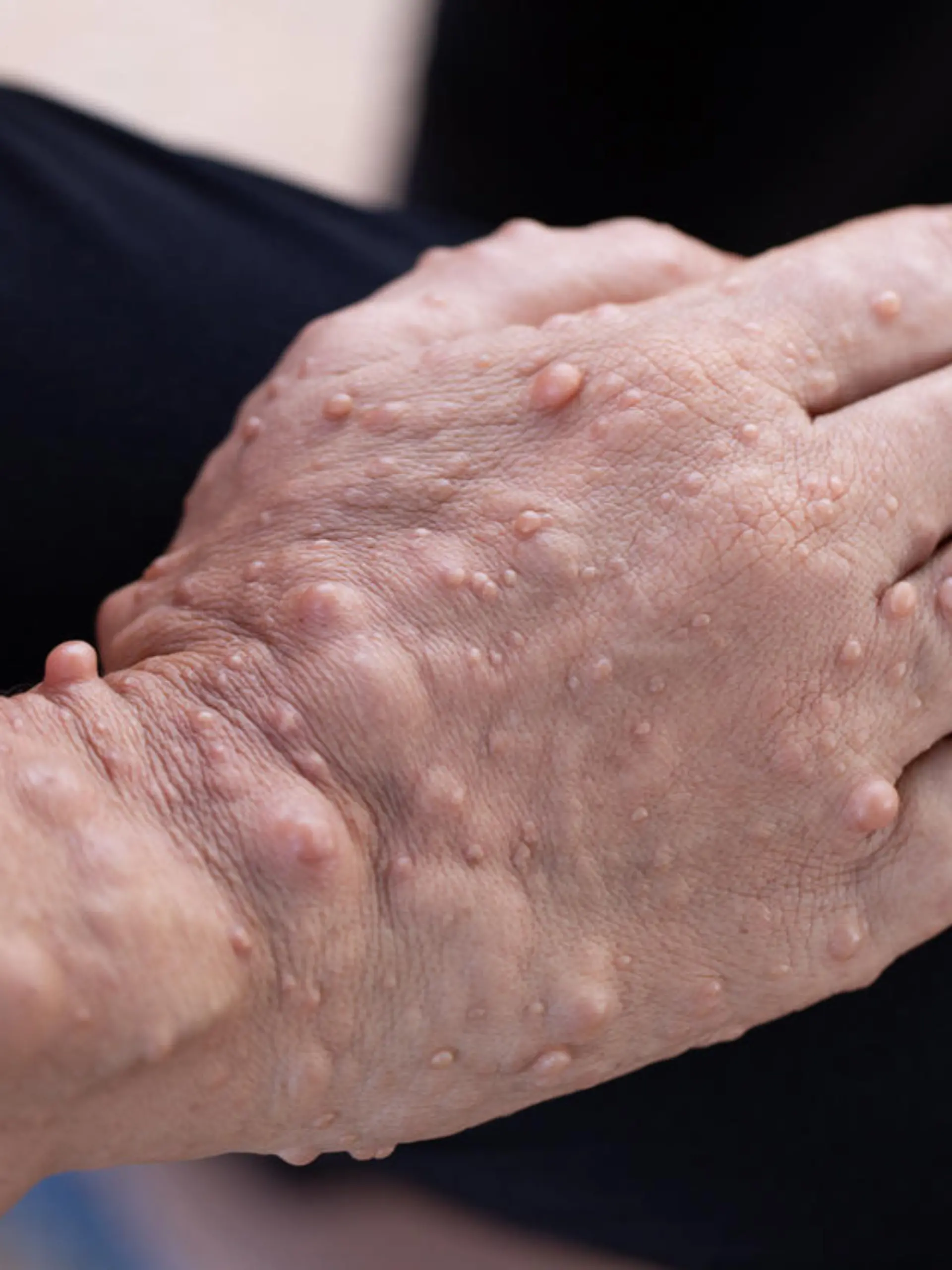 Symptom von Neurofibromatose: Eine Hand mit vielen kleinen Geschwülsten unter der Haut