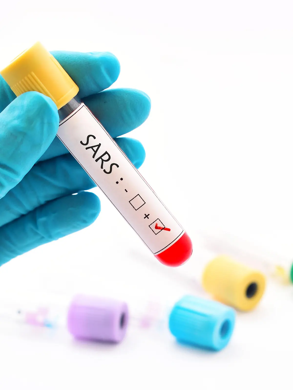 Blutprobe mit positivem SARS-Virus (schweres akutes respiratorisches Syndrom)