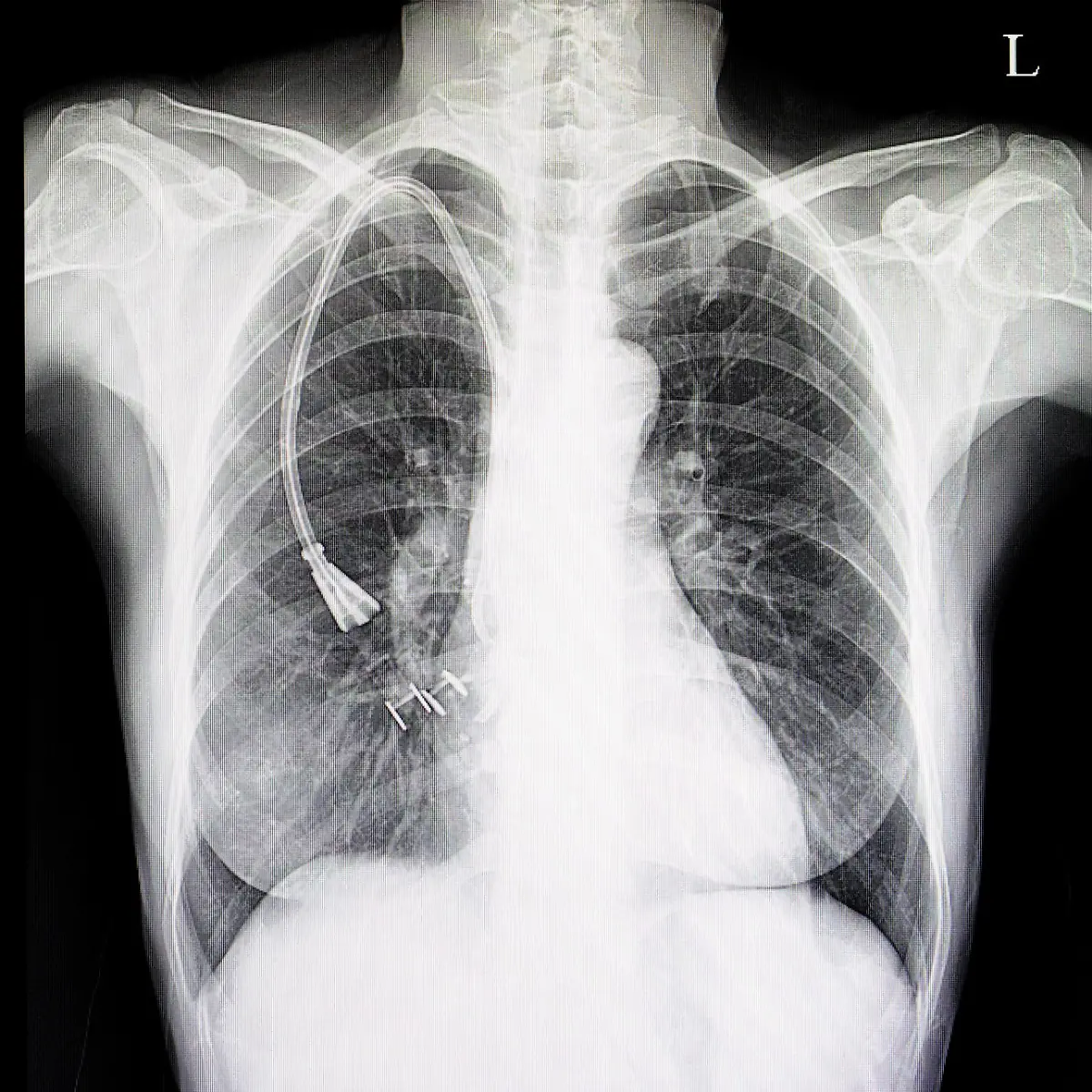 Thoraxdrainage (Pleuradrainage) Logo von Thoraxdrainage (Pleuradrainage)