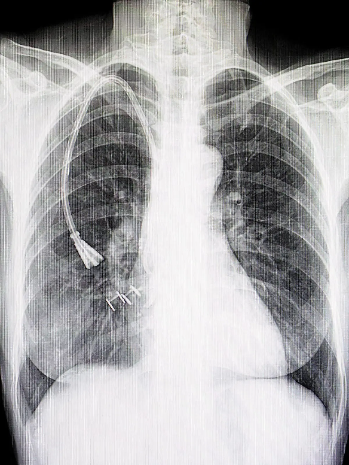 Gesundheitslexikon: Thoraxdrainage