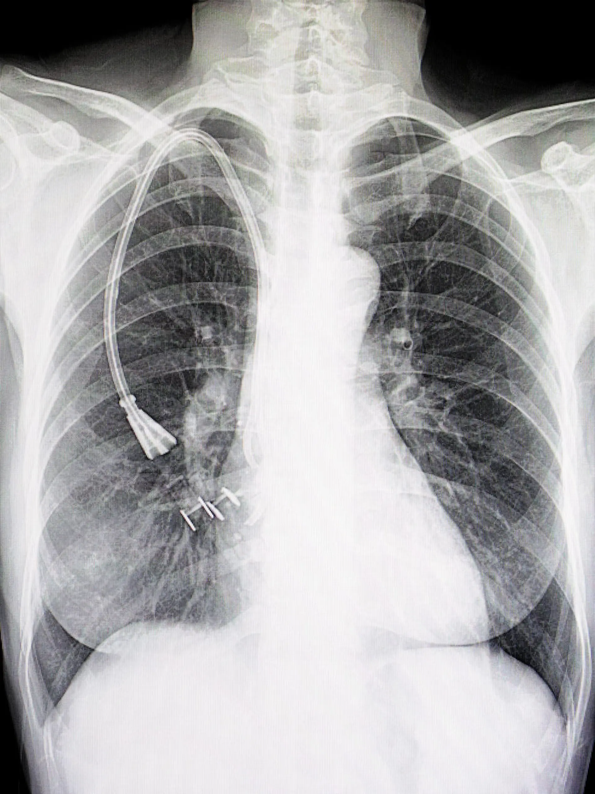 Gesundheitslexikon: Thoraxdrainage