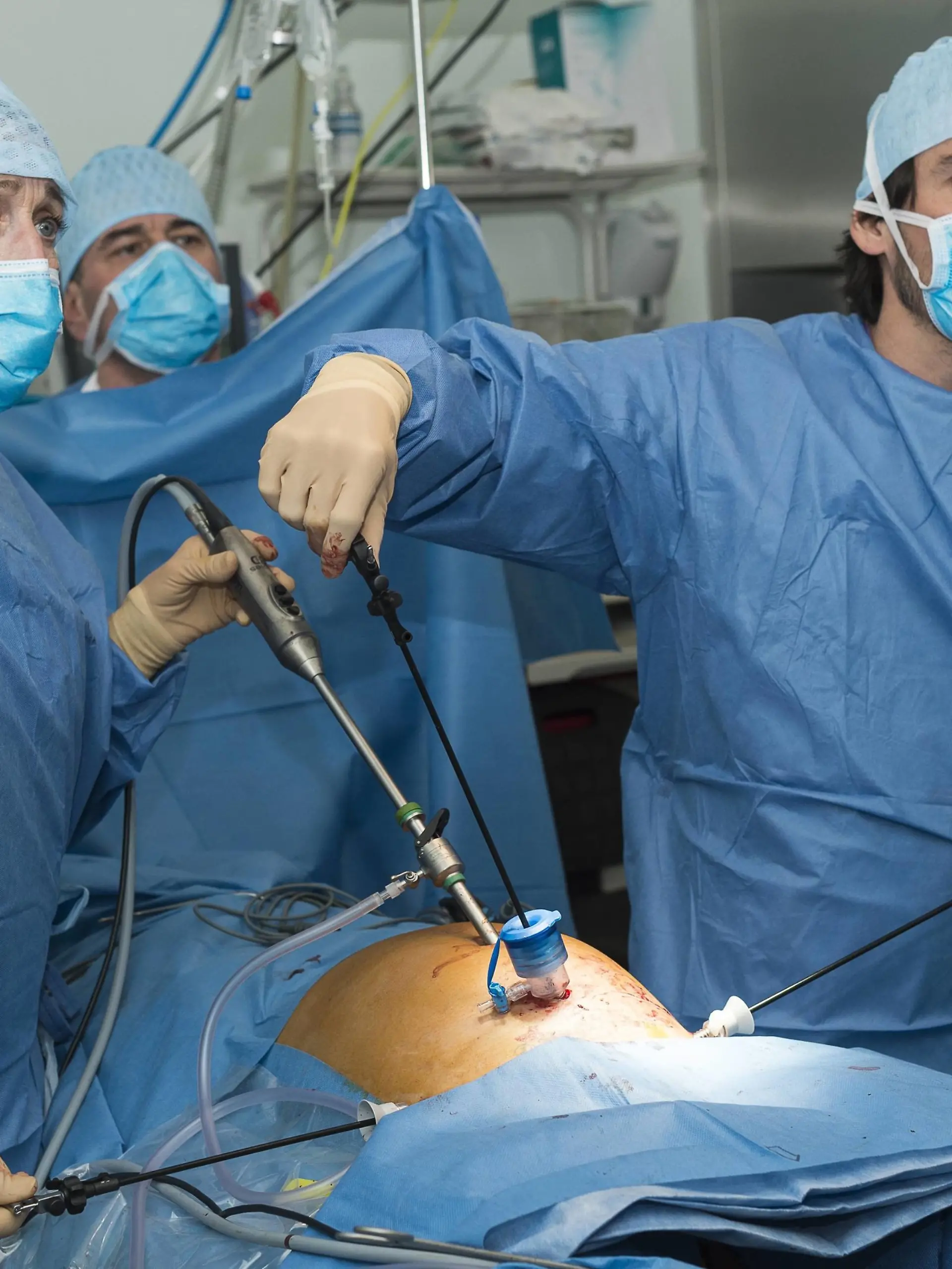 Reportage in the gynecology theatre block in Lenval Clinic, Nice, France. Laparoscopy removal of a fibroma. | Verwendung weltweit, Keine Weitergabe an Wiederverkäufer.