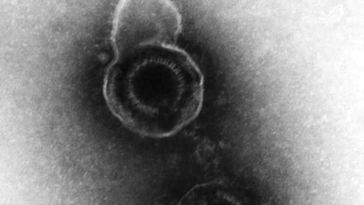Ist das Immunsystem geschwächt, kann das Varicella-Zoster-Virus eine Gürtelrose (Herpes zoster) auslösen. Foto: RKI/Hans R. Gelderblom