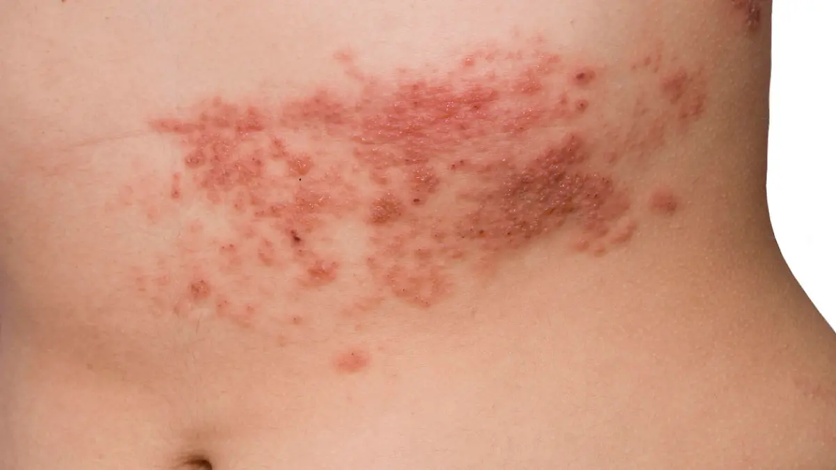 Typischer Hautausschlag bei einer Gürtelrose (Herpes zoster)