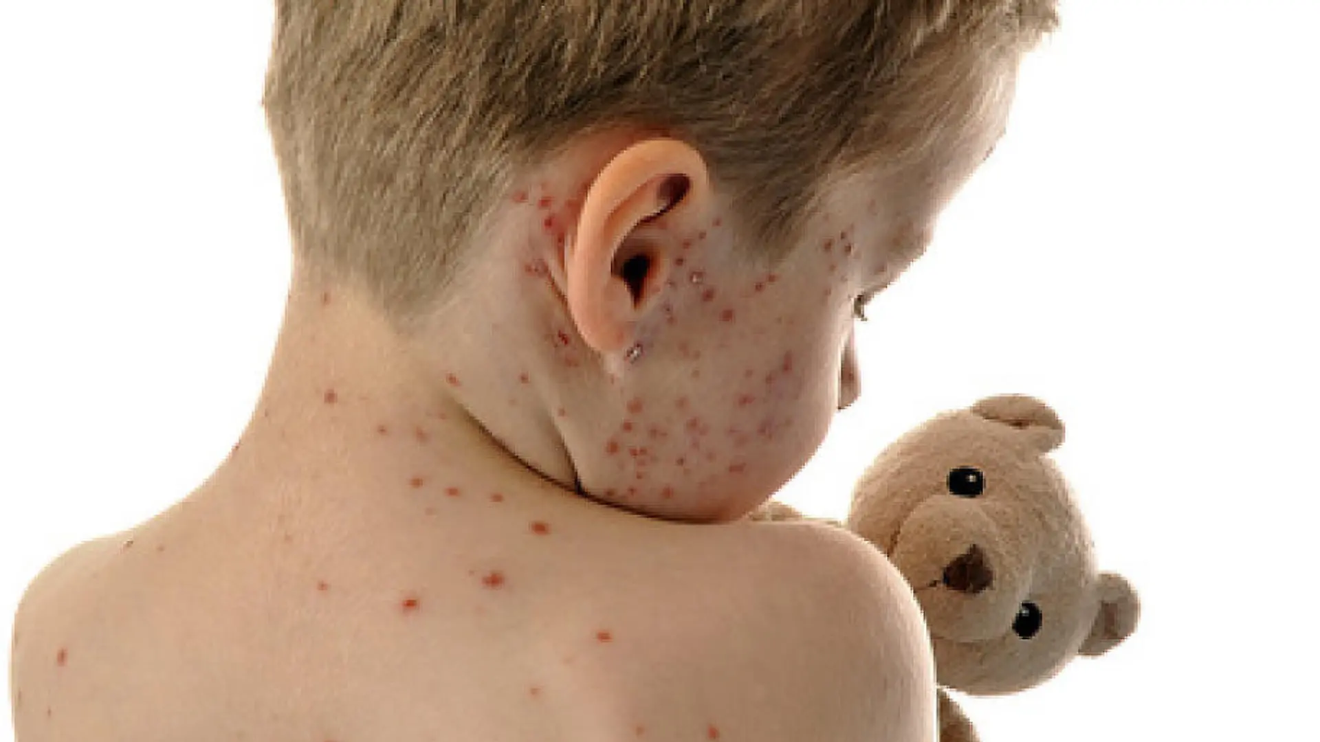 Forscher warnen: Nur 63 Prozent der Kinder sind geschützt Masern: Ist eine Impfpflicht notwendig?