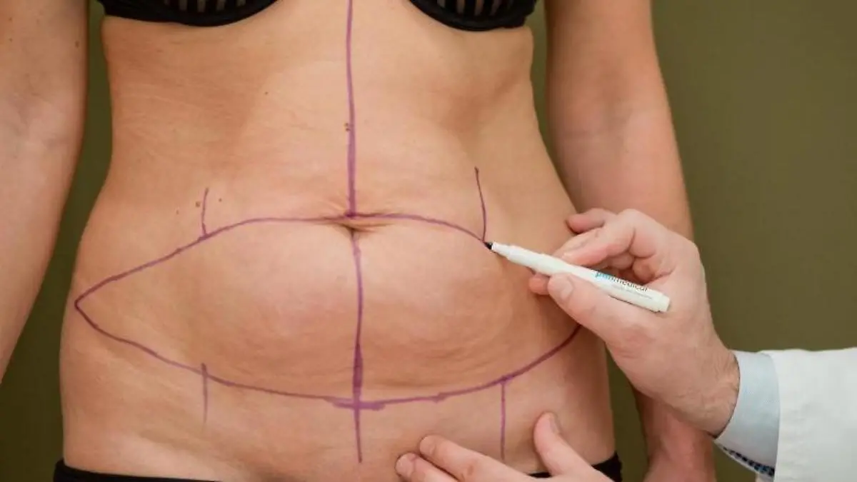 Vor der Operation zeichnet Dr. Jens Baetge, Facharzt für plastisch-ästhetische Chirurgie und Chefarzt an der Nürnberger Klinik für Ästhetisch-Plastische Chirurgie, die Bauchdeckenstraffung vor. Foto: Daniel Karmann