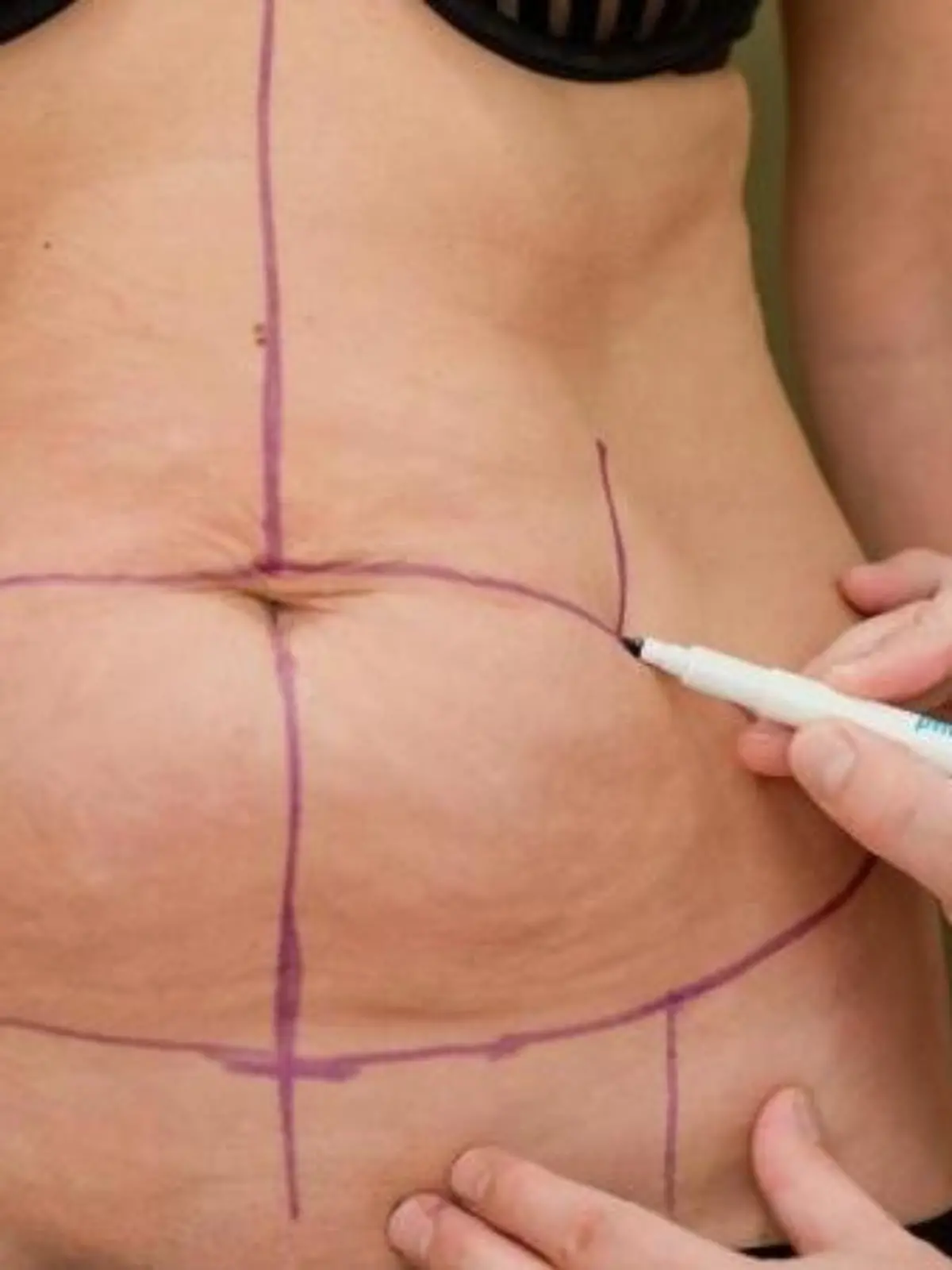Vor der Operation zeichnet Dr. Jens Baetge, Facharzt für plastisch-ästhetische Chirurgie und Chefarzt an der Nürnberger Klinik für Ästhetisch-Plastische Chirurgie, die Bauchdeckenstraffung vor. Foto: Daniel Karmann