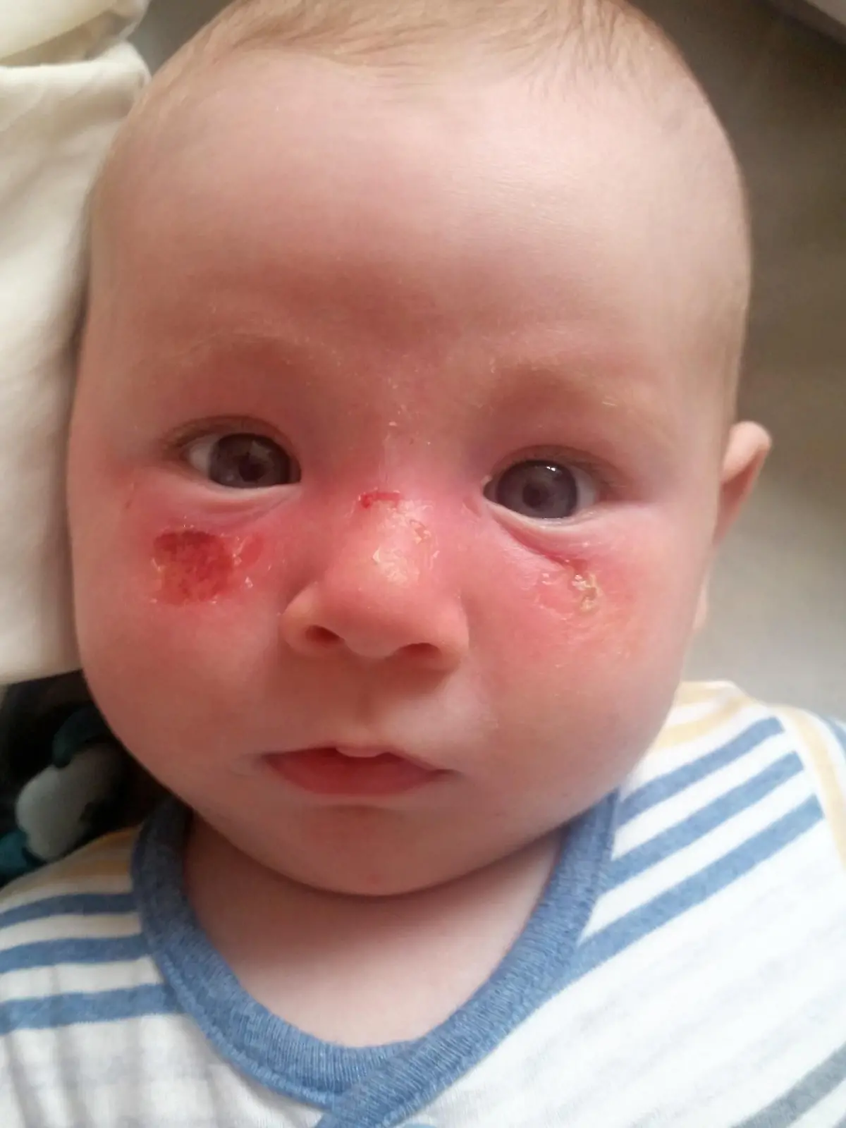 PIC FROM CATERS NEWS - (PICTURED: Baby Jacob after he got a sun burn.) - A four month old baby has been left with severe sun burn across his face after cloudy day out at the seaside. Young mum, Alex Dodds, 20, from County Down, Northern Ireland, was left distraught when a day at the seaside left her baby, Jacob, with huge blisters. Alex had applied sun cream but did not reapply it after the weather seemed to be taking a turn for the worst. The redness and blisters did not appear until the day after which terrified Alex, who was worried strangers would assume she was a bad parent. She is now sharing her story as a warning to other mums about the UK weather and how strong the sun can be, even through the clouds. SEE CATERS COPY.