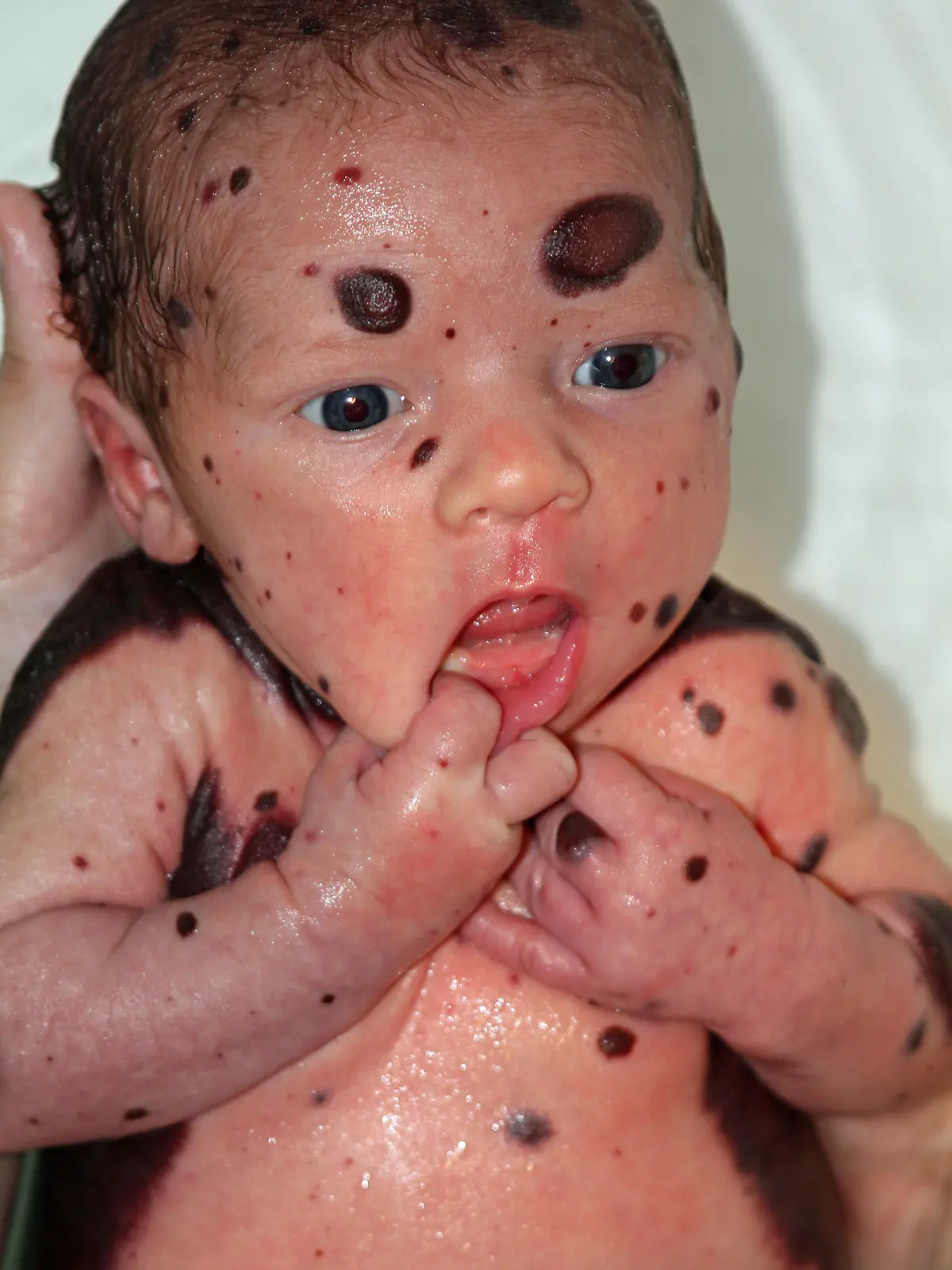 PICS BY KARA LITTLE / CATERS NEWS - (PICTURED: Dylan has large nevus moles covering more than 80% of his body, the largest is situated on his back stretching from ear to his bottom) - A boy is having breast implants to save his life after his mum fears the moles covering 80% of his body will turn into fatal cancer. Dylan Little, from Atlanta in Georgia, USA, was born with giant Congenital Melanocytic Nevus  a rare condition affecting one in every 20,000. Moles covered 80% of the babys body, with the largest stretching from above his ear to his bottom and others ranging from the size of a dot to half a dollar. His parents Kara and Nikki, 38 and 33, fear the moles will turn into fatal skin cancer and have started their son on surgery to remove the largest areas. - SEE CATERS COPY