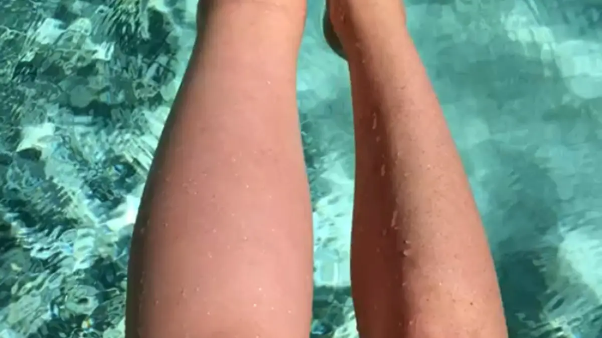 PIC FROM CATERS NEWS - (PICTURED: The difference in size between Sarahs legs. ) - A former model has been left with a ginormous leg after her pregnancy caused the limb to double in size. Sarah Buller, 31, from Perth, Australia, was left horrified when her left leg began ballooning when she was three months pregnant. Doctors diagnosed Sarah with primary lymphoedema - an incurable condition that causes swelling in the bodys tissues - after shed given birth. Sarahs pregnancy had triggered a chronic problem with her lymphatic system, meaning the lymph fluid is unable to circulate around her leg properly now leaving it weighing two stone. The mum-of-two, currently living in Nice, France, now spends hours every day bandaging her leg, using compression socks, exercising and having massages in a bid to relieve the excess fluid. SEE CATERS COPY.