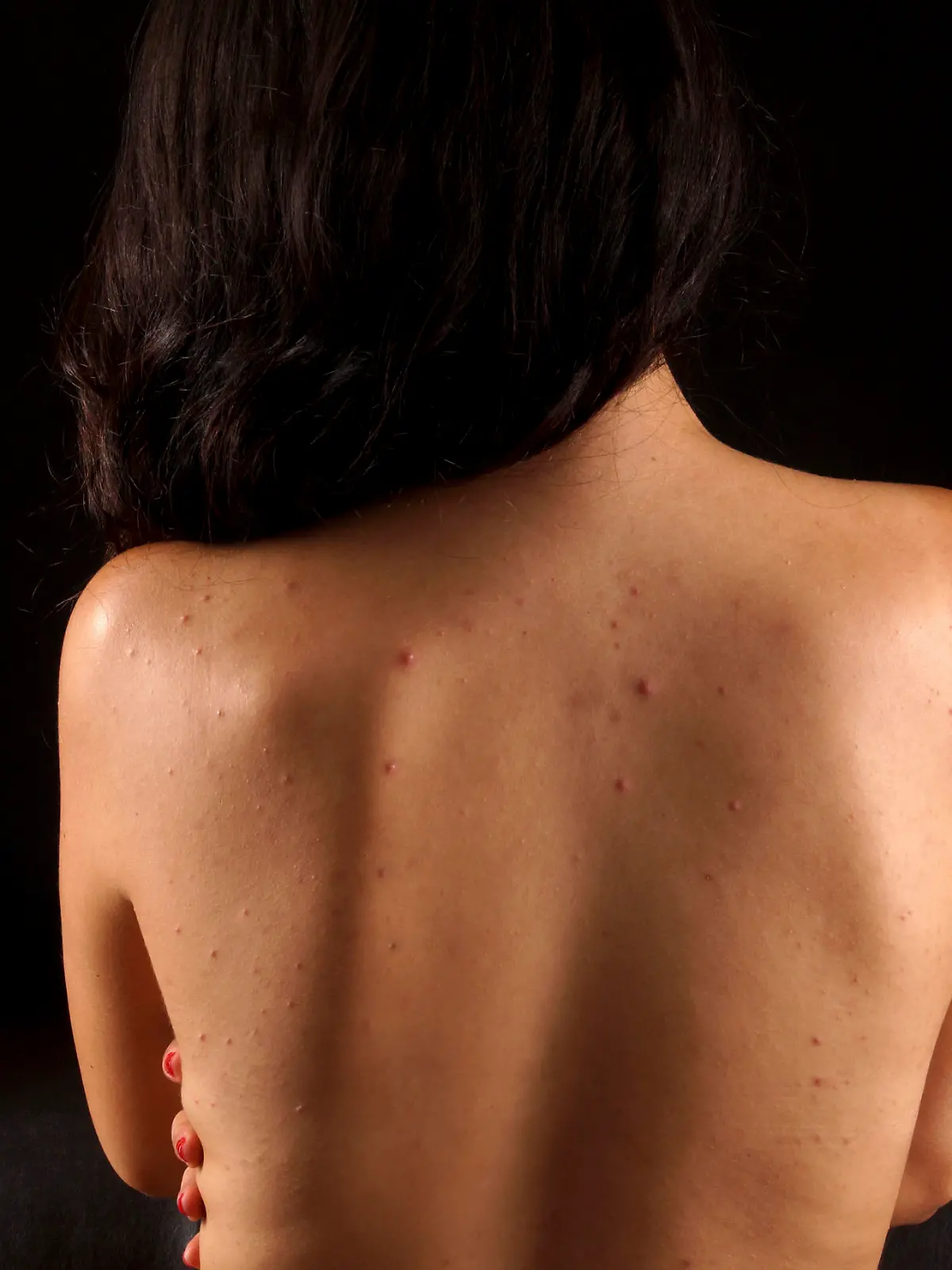 acne on a females back