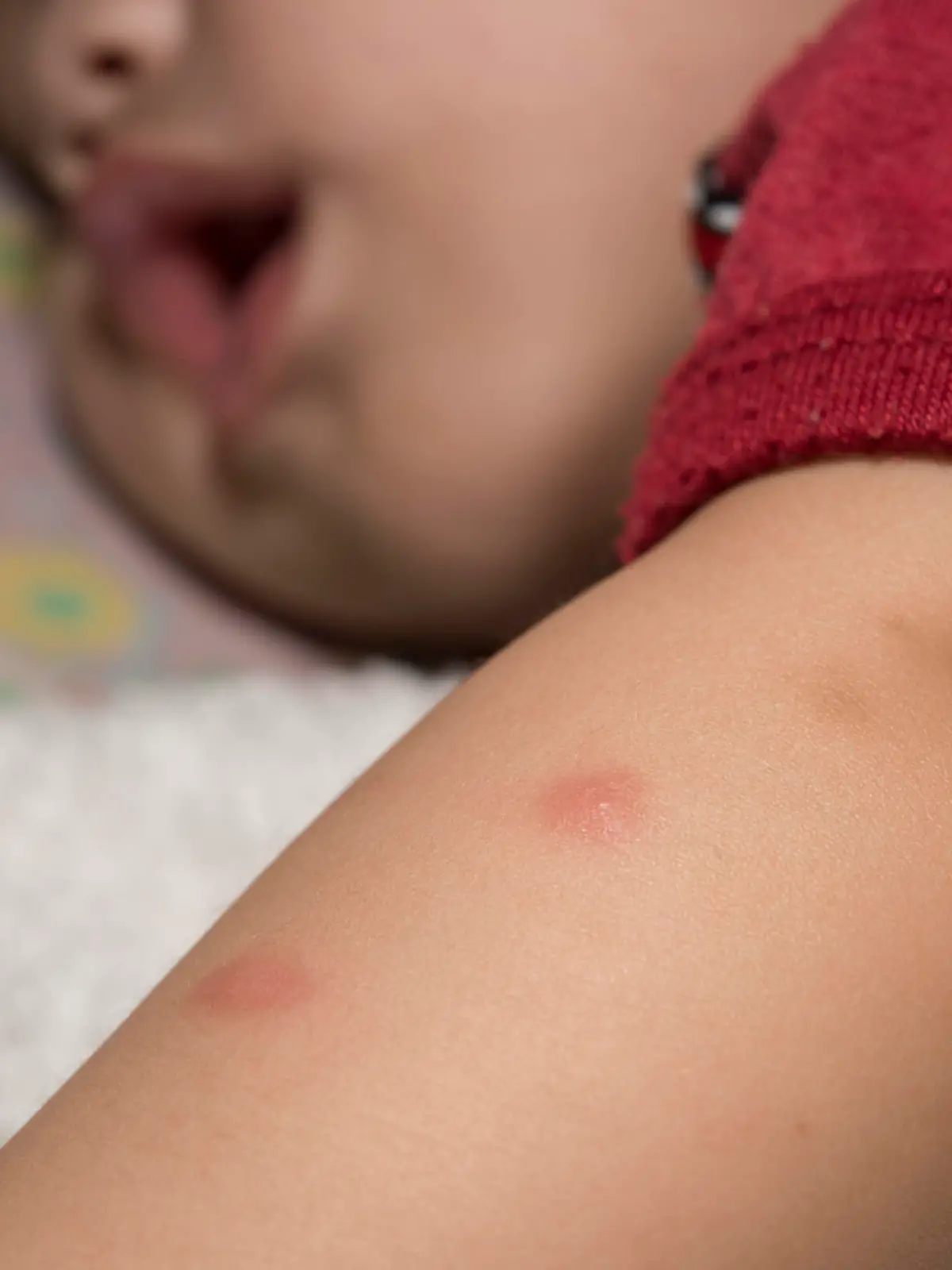 Baby is sleeping mosquito bites the arm