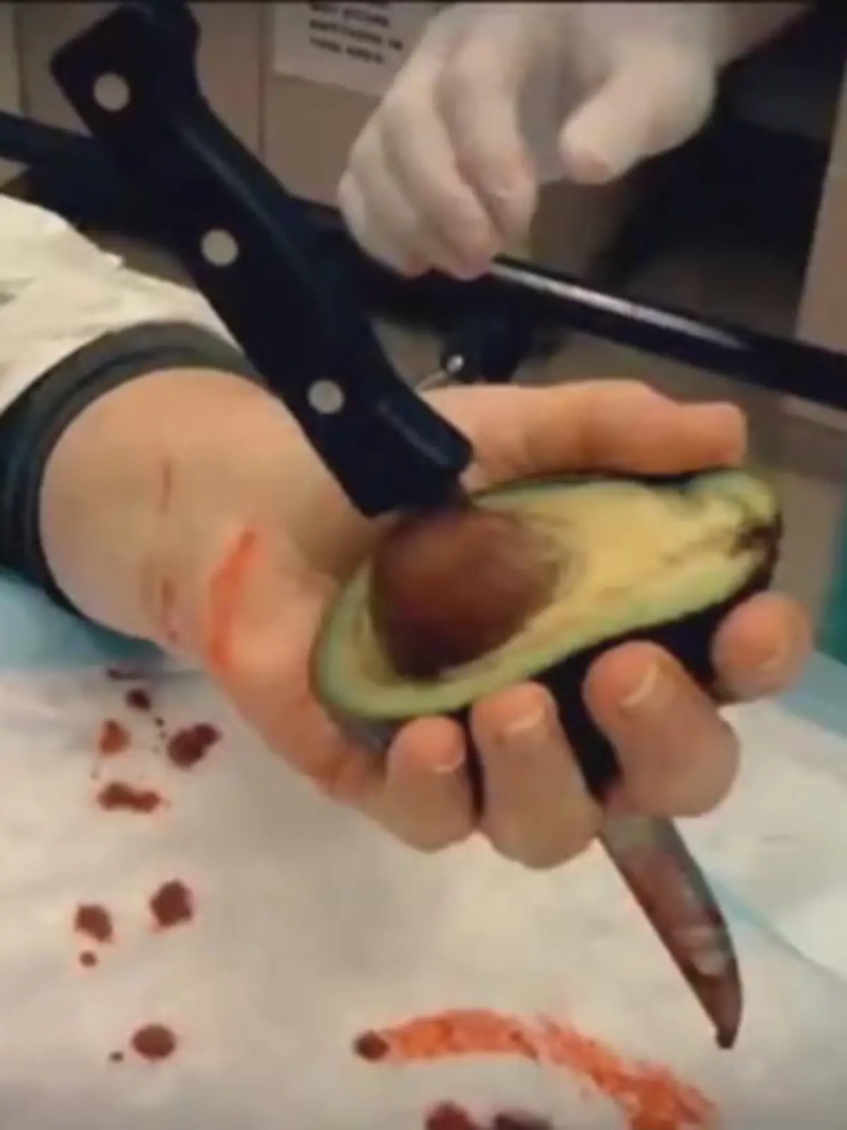 Bild zu: "Autsch! Passen Sie auf beim Avocado-Schneiden"