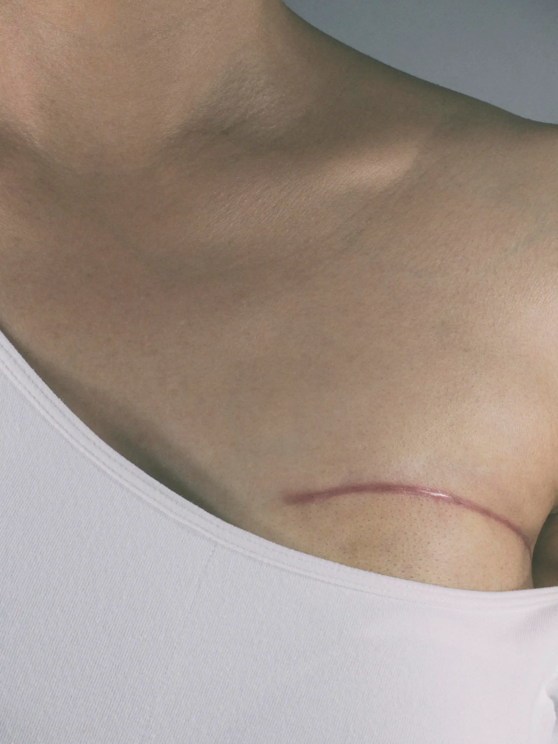 Breast cancer surgery scars by partial mastectomy. With effect filter.