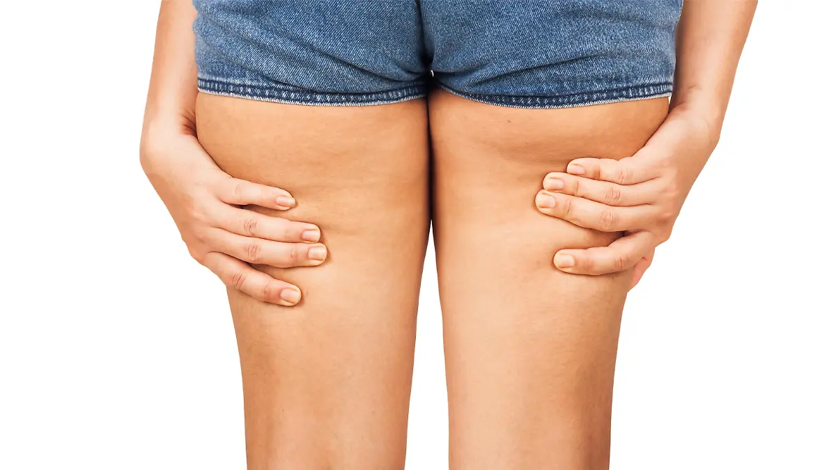 Fat thighs, cellulite of a teenage girl.