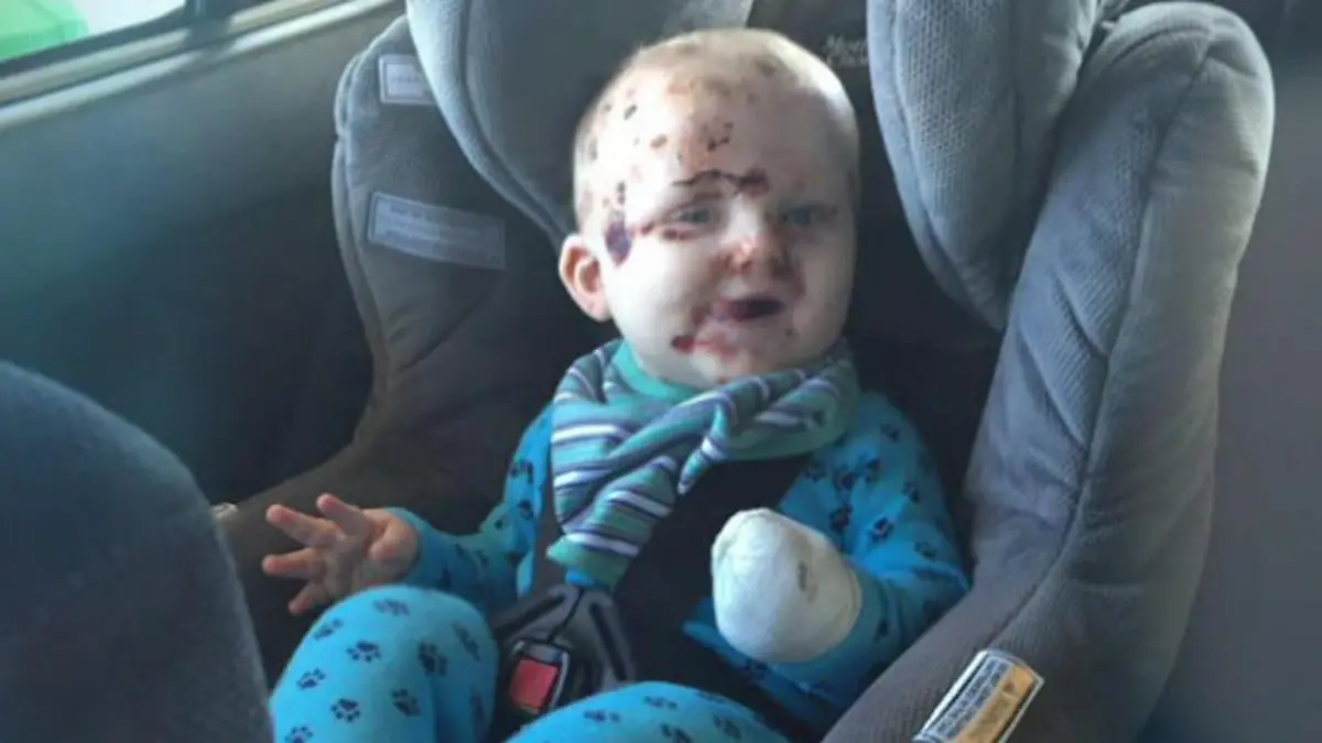 Windpocken-Horror bei Säugling: eine Mutter will warnen Darum ist eine Impfung so wichtig