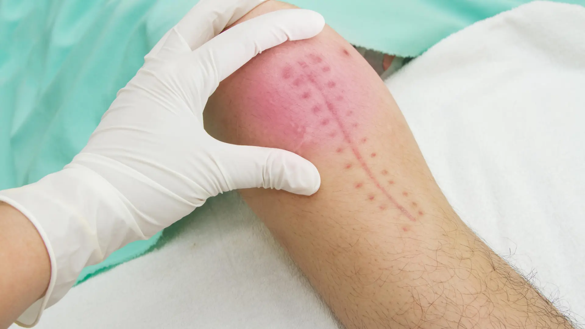 Hands of physiotherapist treatment the knee joint, Patient demonstrating surgery wound