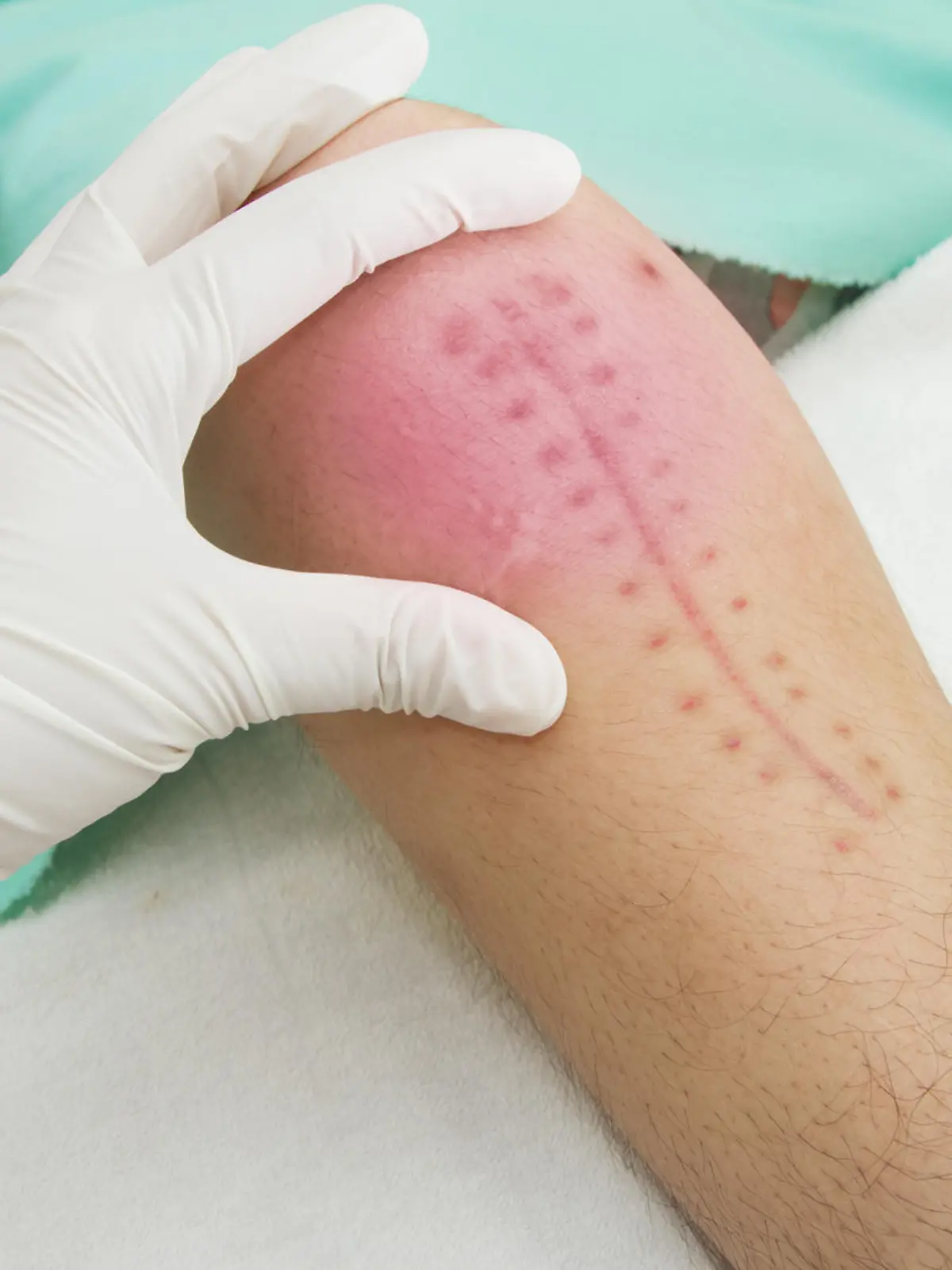 Hands of physiotherapist treatment  the knee joint, Patient demonstrating surgery wound 