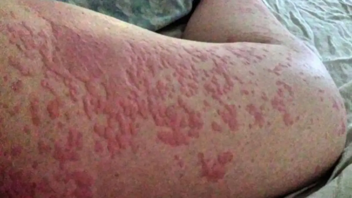 (c) JULIE REID allergisch gegen Schweiß