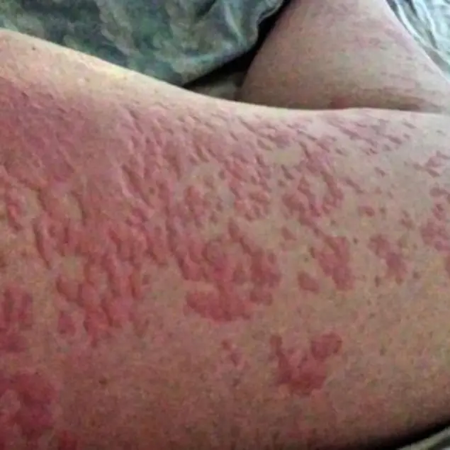 Urtikaria: Wenn der Krper allergisch auf Schwei reagiert